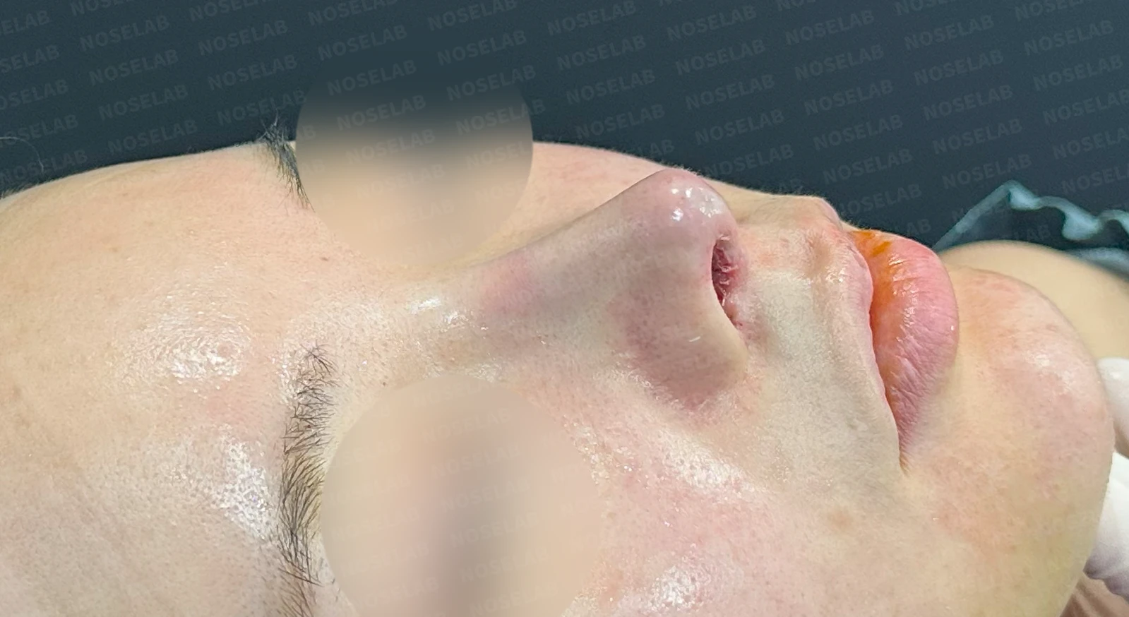 코끝 피부 상태와 괴사 위험을 고려한 재수술 계획 — 수술 전 / 수술 직후 0일 직후 사진은 부기가 있는 상태로 최종 결과와 다를 수 있습니다.