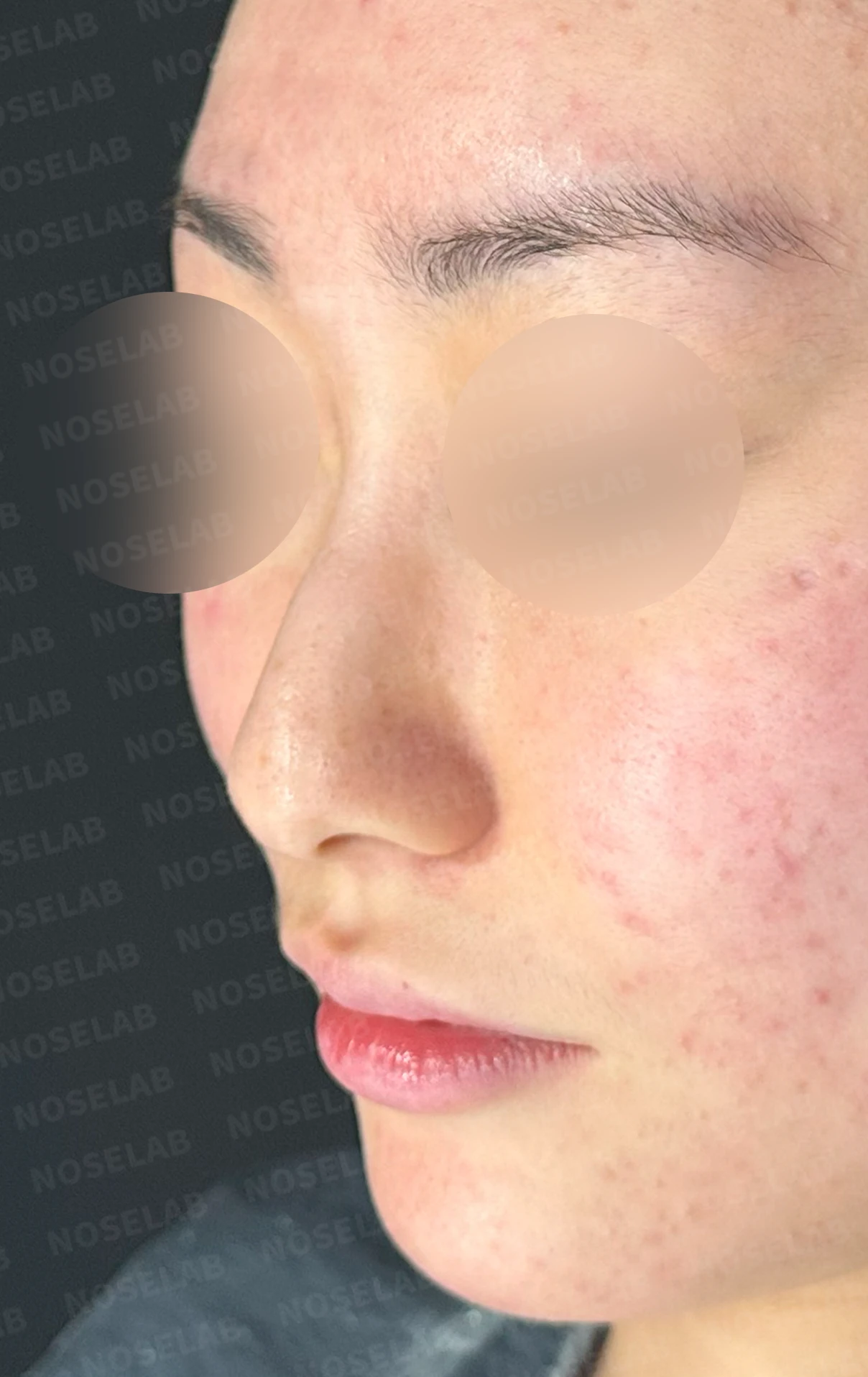 코끝이 뭉툭하게 퍼지고 코가 휘어 보이는 이유, 늑연골 재건은 어떻게 하나 — 수술 전 / 수술 직후 0일 직후 사진은 부기가 있는 상태로 최종 결과와 다를 수 있습니다.