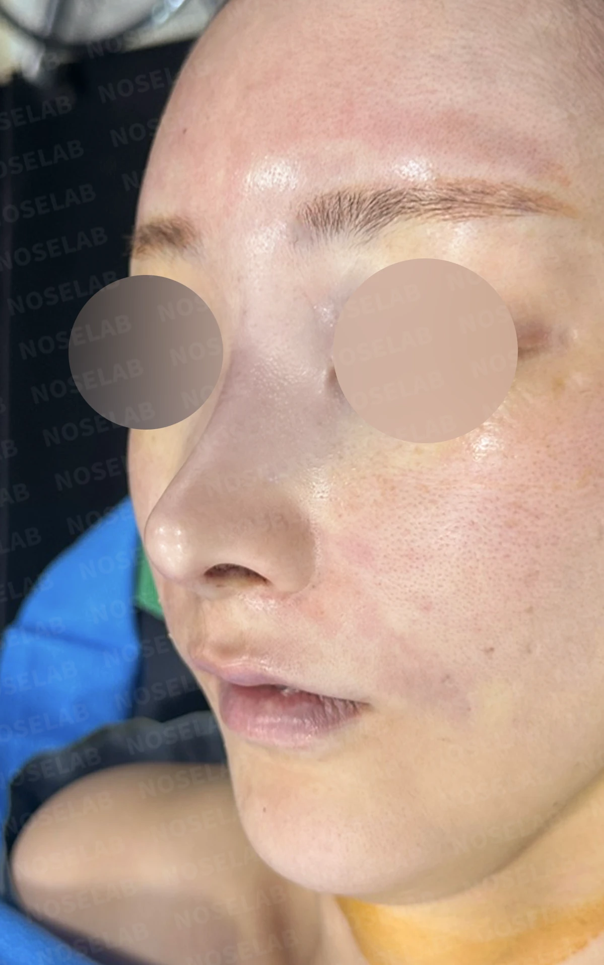 녹이지 않은 코필러가 퍼지고 축농증이 겹칠 때, 제거와 교정은 어떻게 하나 — 수술 직후 0일 정면, 비스듬한 측면, 측면 사진입니다. 직후 사진은 부기가 있는 상태로 최종 결과와 다를 수 있습니다.