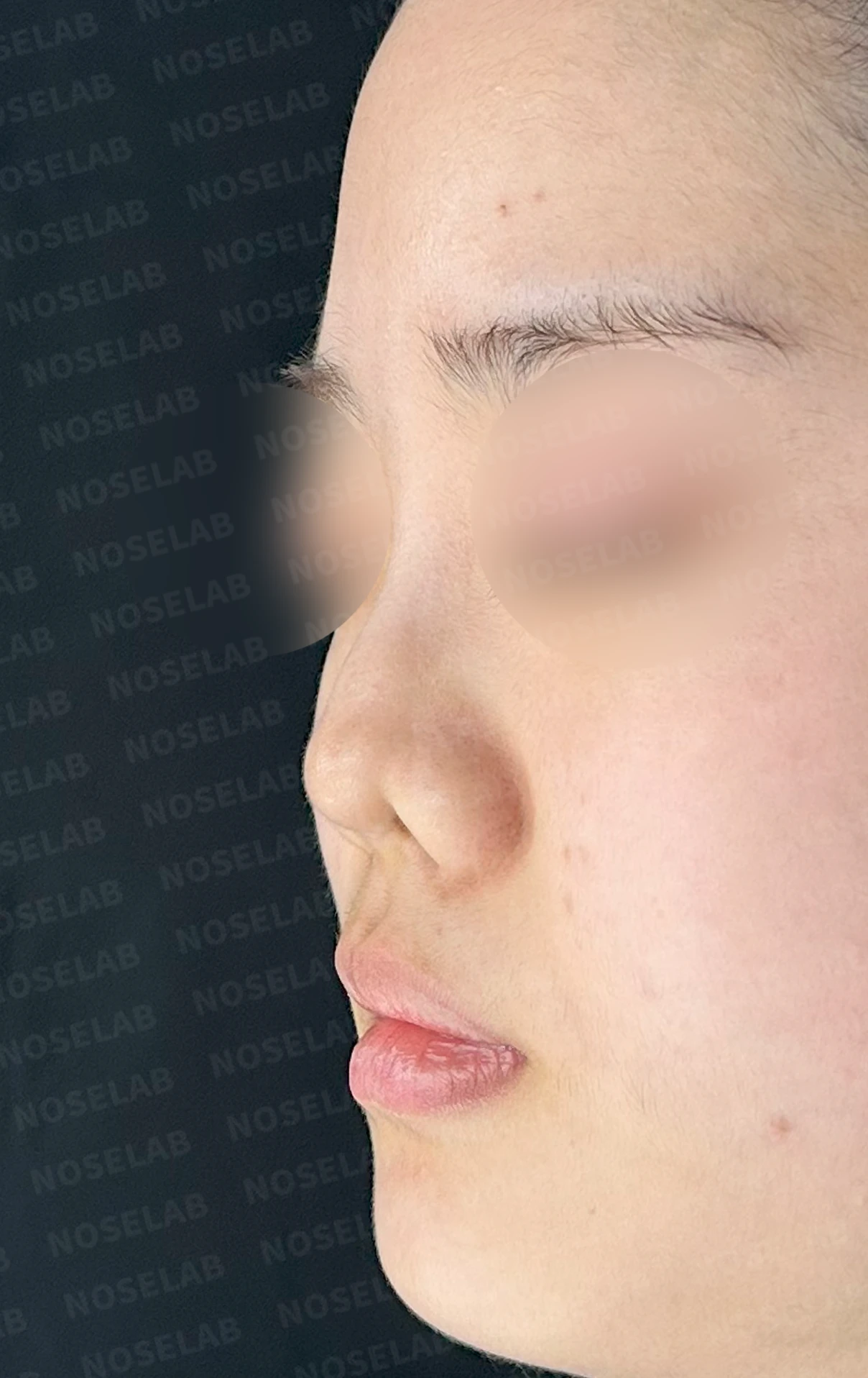 이전 수술 뒤 콧구멍이 좁아지는 비공협착, 원인과 재건 방법 — 수술 전 / 수술 직후 0일 — 비스듬한 측면 사진입니다. 직후 사진은 부기가 있는 상태로 최종 결과와 다를 수 있습니다.