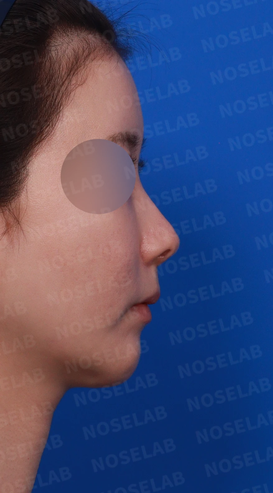 코성형 후 남는 미세한 높이 부족과 좌우 비대칭, 왜 생기고 어떻게 보강하나 — 디자인 상담 우측 비스듬한 측면 , 측면 , 비공 사진입니다.