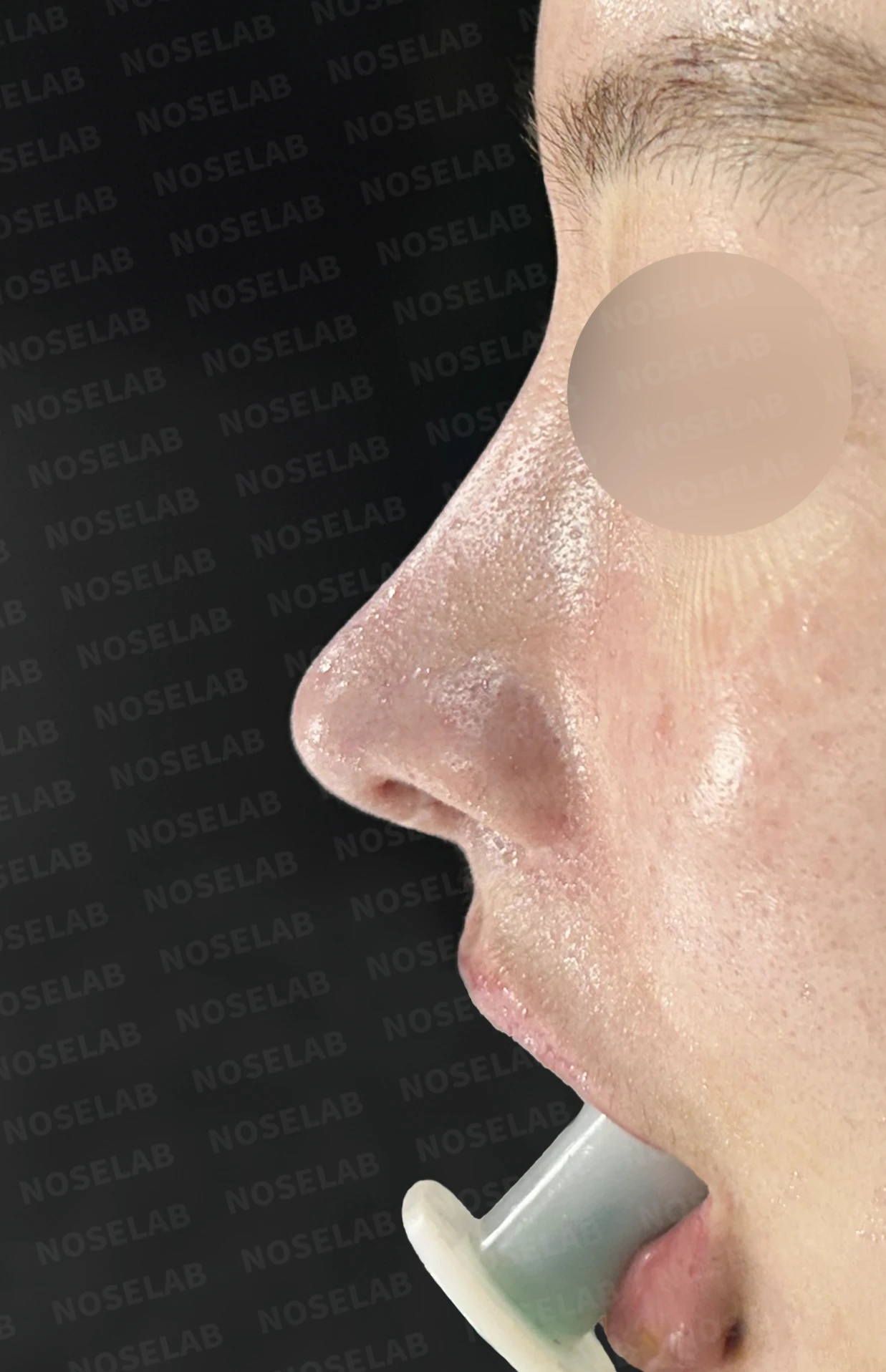 이물질 제거와 자가늑연골 비중격 재건, 들린 코 교정한 코재수술 — 직후 정면, 비스듬한 측면, 측면 사진입니다.