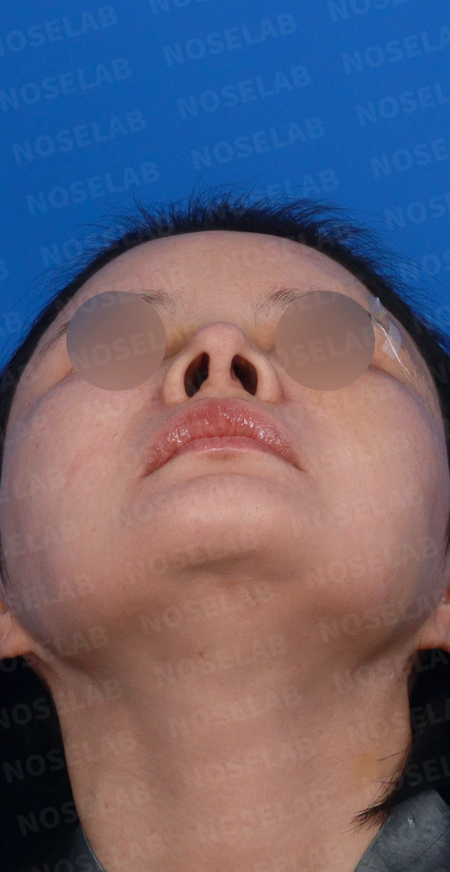 외상으로 코뼈가 부러지면 코가 어떻게 변형되고, 정복과 재건은 어떻게 하나 — 디자인 상담 우측 측면, 비스듬한 측면, 비공 사진입니다.