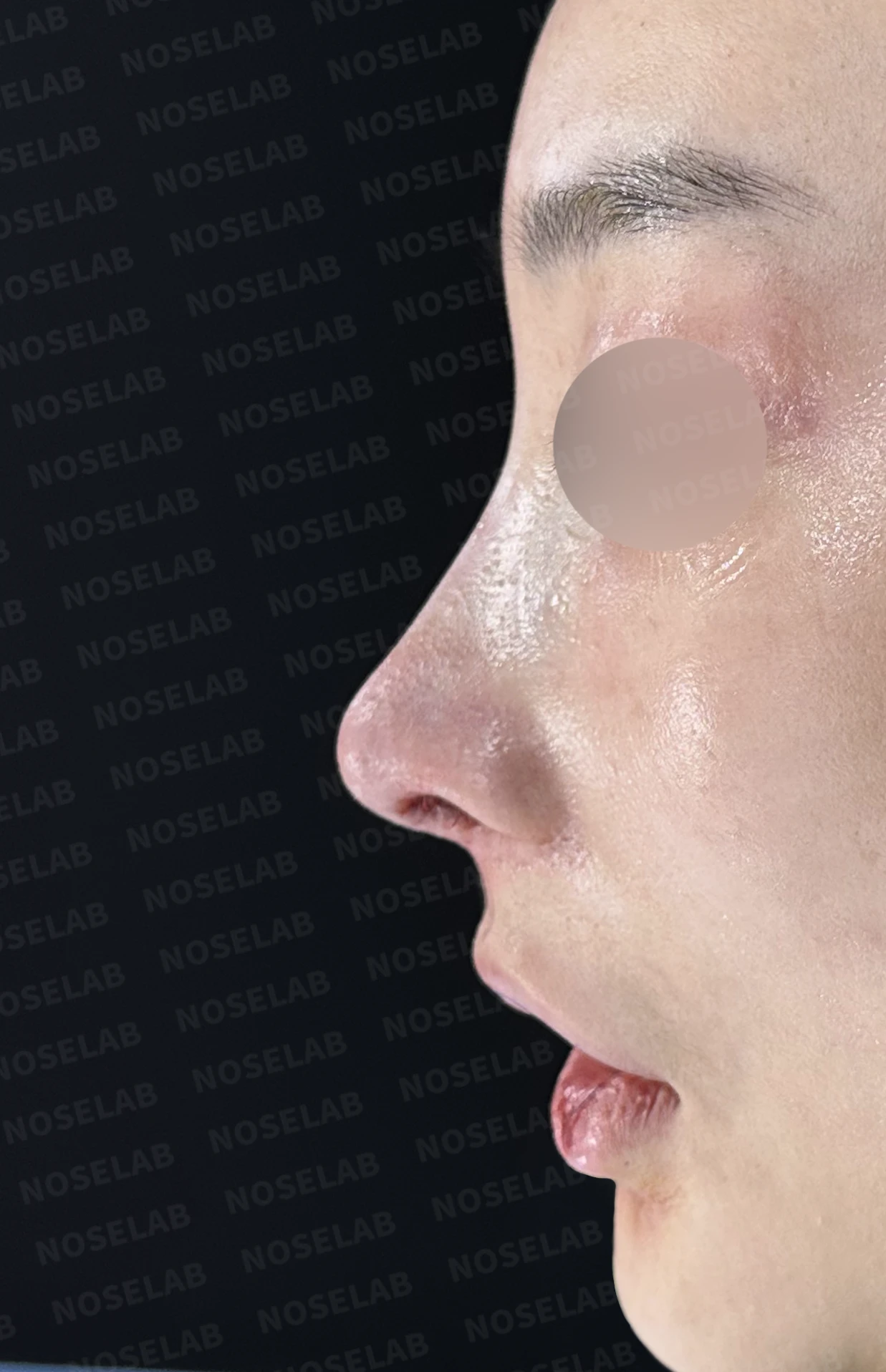 휘어진 코와 퍼진 코끝, 자가늑연골로 세련된 직반라인 완성한 코재수술 — 전(좌) 직후(후)