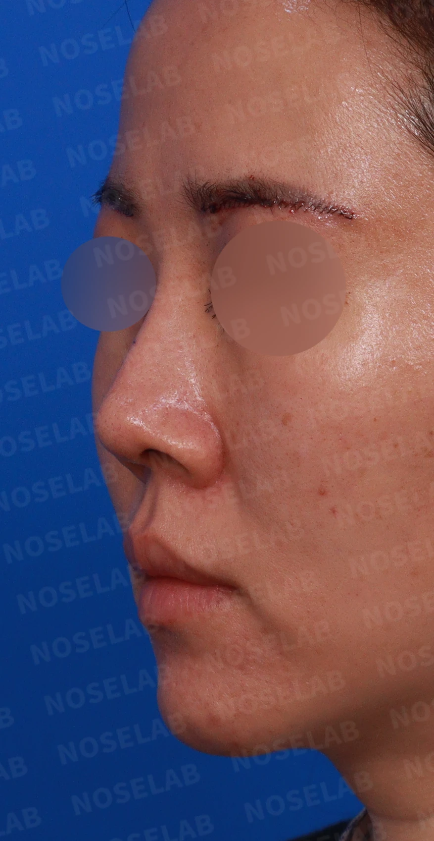비주 내리기와 비순각 교정을 함께 계획하는 방법 — 디자인 상담 정면, 좌측 측면, 비스듬한 측면 사진입니다.