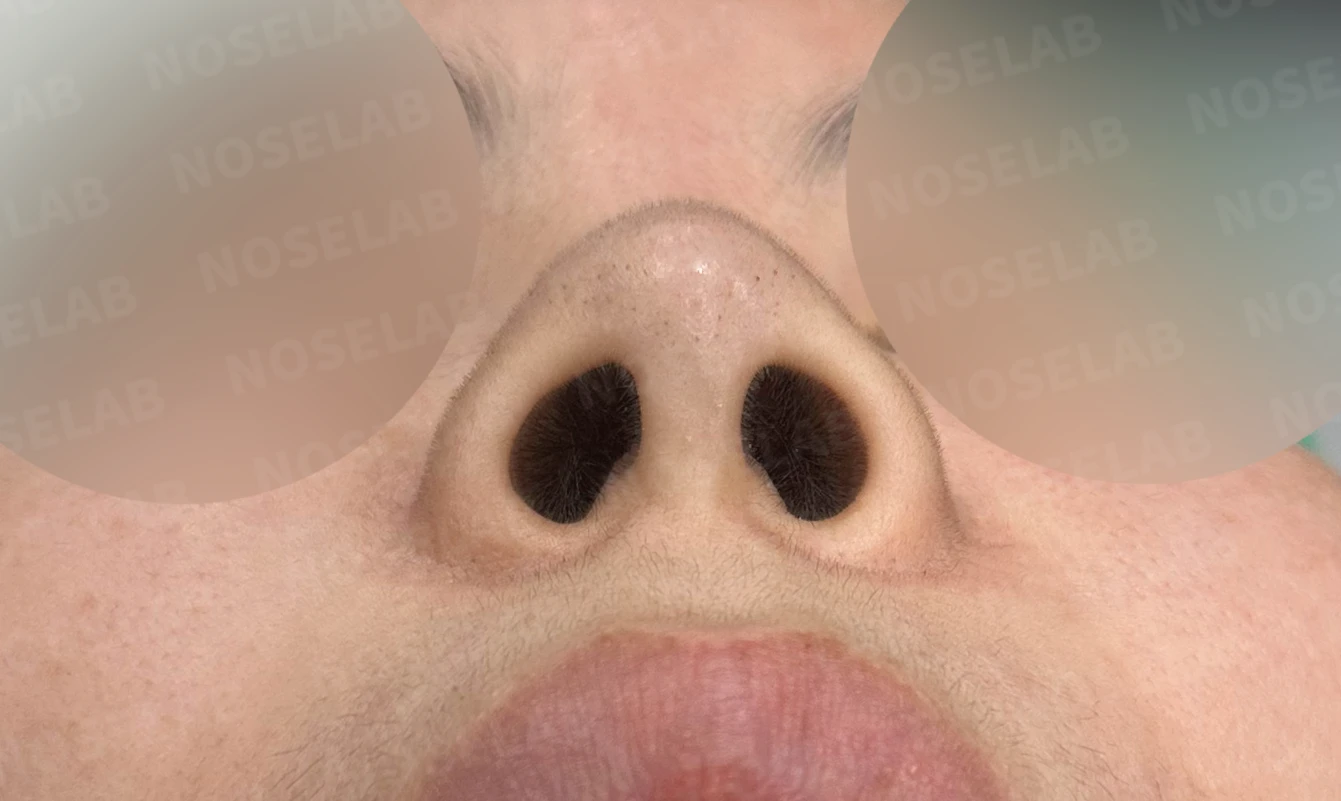 L자 실리콘 보형물이 비주 점막을 뚫기 직전까지 가는 이유, 제거와 자가늑연골 재건 방법 — 수술 전 / 수술 직후 0일 직후 사진은 부기가 있는 상태로 최종 결과와 다를 수 있습니다.