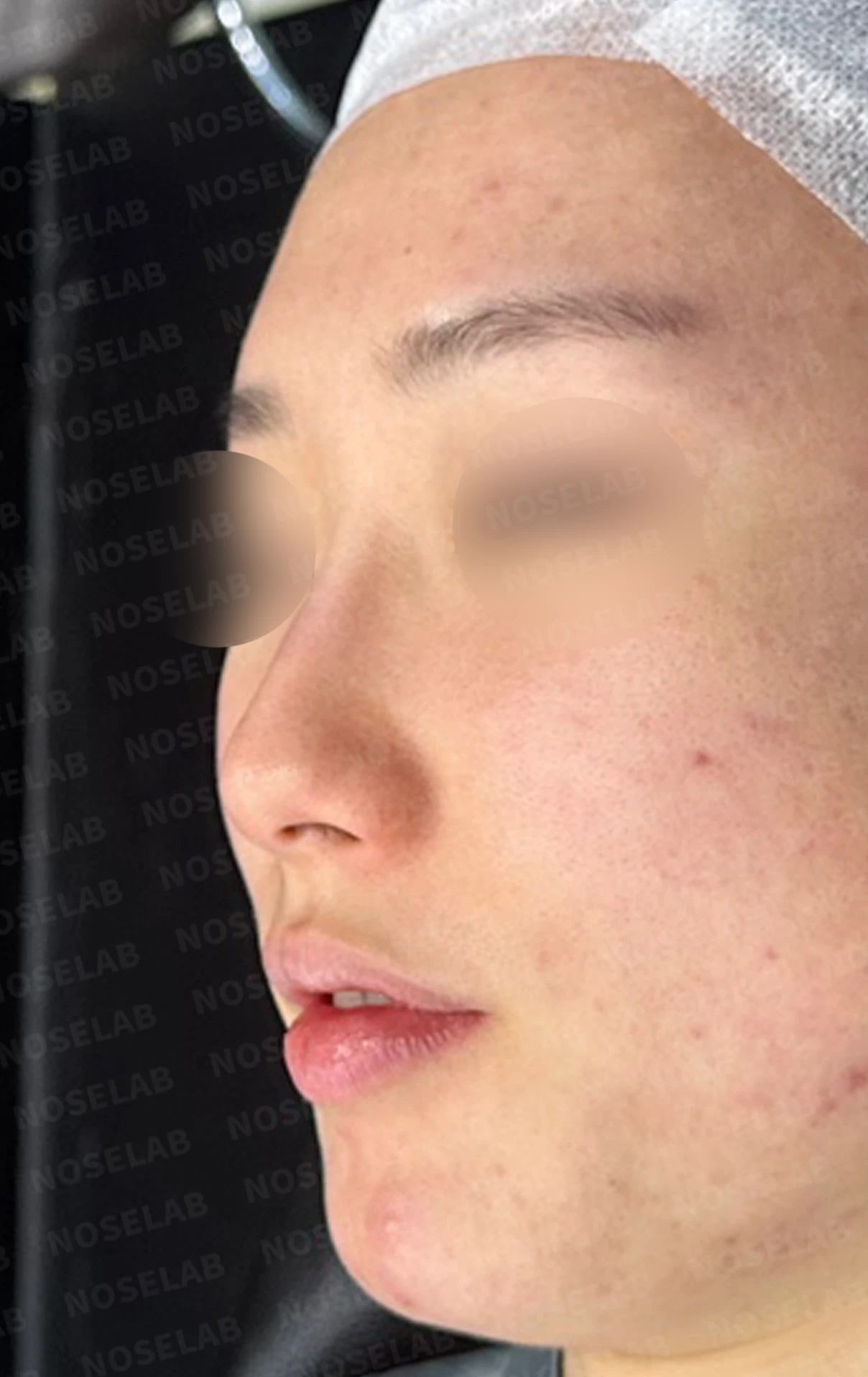 코 필러 뒤에도 휜 코와 코막힘이 남는 이유, 교정은 어떻게 하나 — 수술 전 / 수술 직후 0일 직후 사진은 부기가 있는 상태로 최종 결과와 다를 수 있습니다.