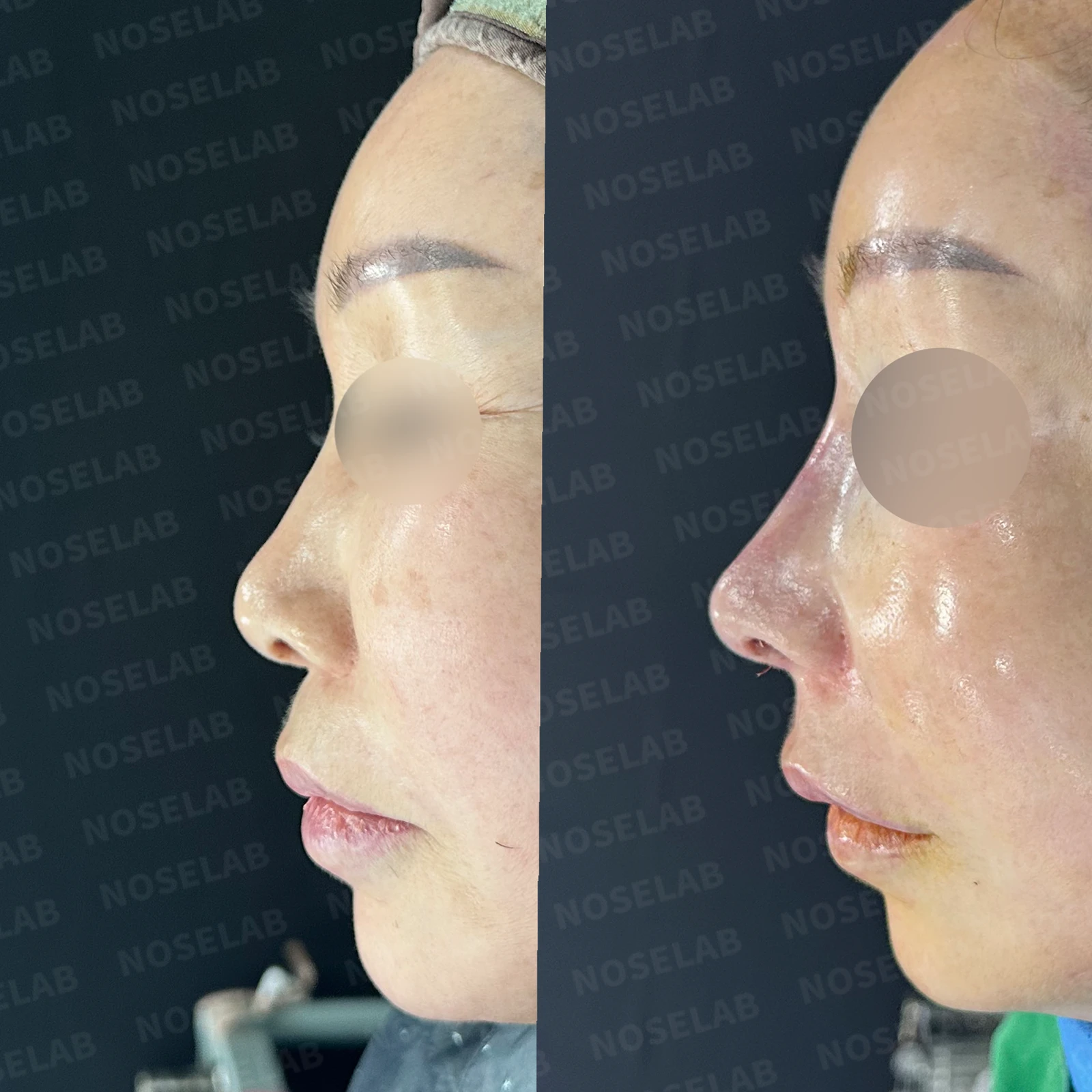 코 안에 남은 메드포어와 이물질, 왜 문제가 되고 어떻게 제거하나 — 본문 사진 22