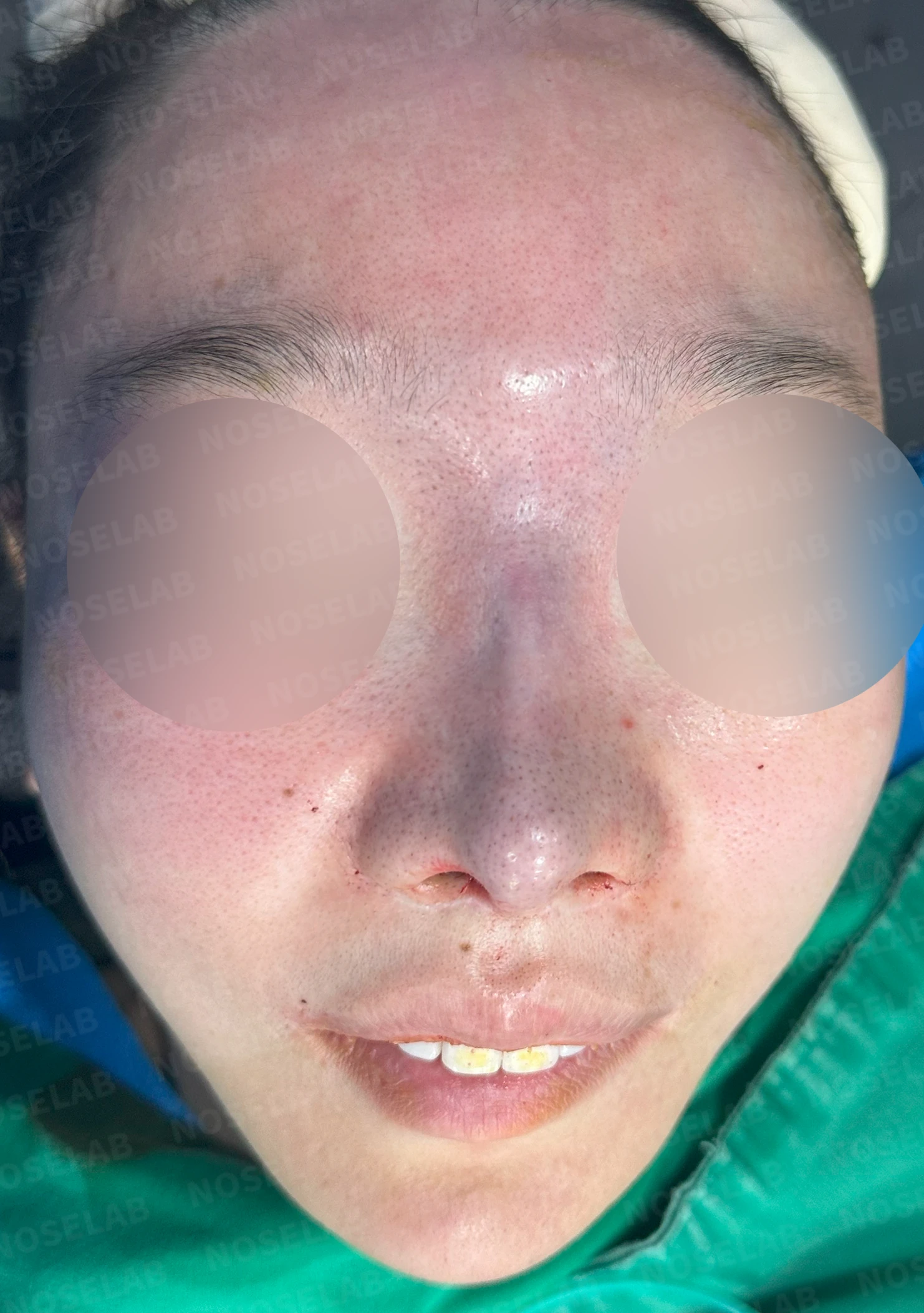 콧대가 뭉툭하게 퍼져 보이는 만성 이물 반응, 원인과 재건 방법 — 수술 전 / 수술 직후 0일 직후 사진은 부기가 있는 상태로 최종 결과와 다를 수 있습니다.
