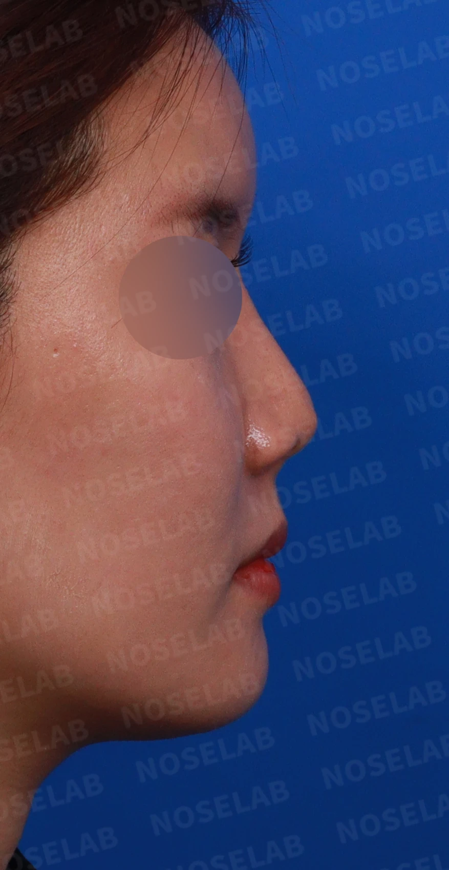 기증 늑연골이 흡수되면 코가 어떻게 변하고, 자가 늑연골 재건은 어떻게 하나 — 디자인 상담 우측 측면 , 비스듬한 측면, 비공 사진