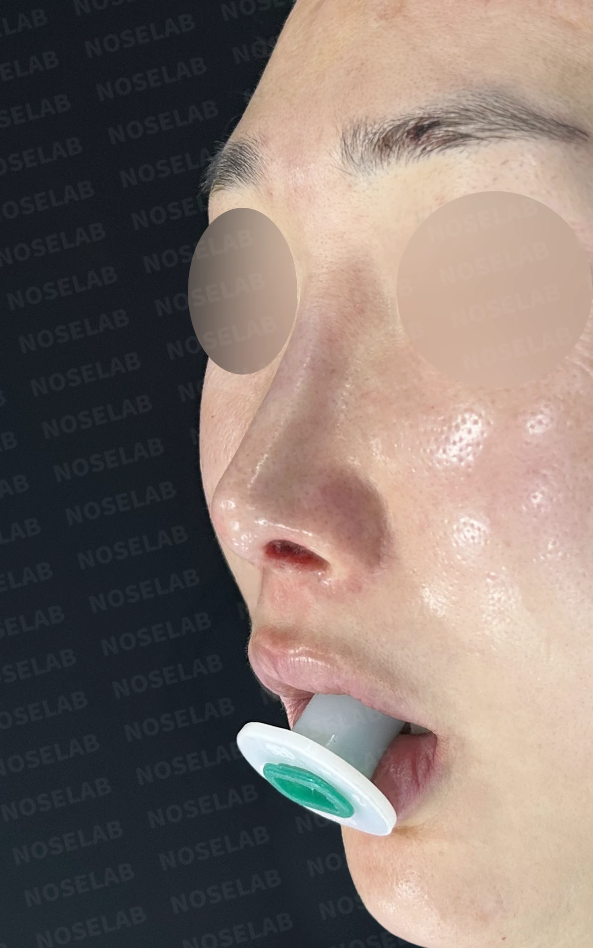 실리콘이 휘고 코가 길어 보이는 이유, 보형물 교체와 늑연골 재건은 어떻게 하나 — 수술 직후 0일 정면, 비스듬한 측면, 측면 사진입니다. 직후 사진은 부기가 있는 상태로 최종 결과와 다를 수 있습니다.