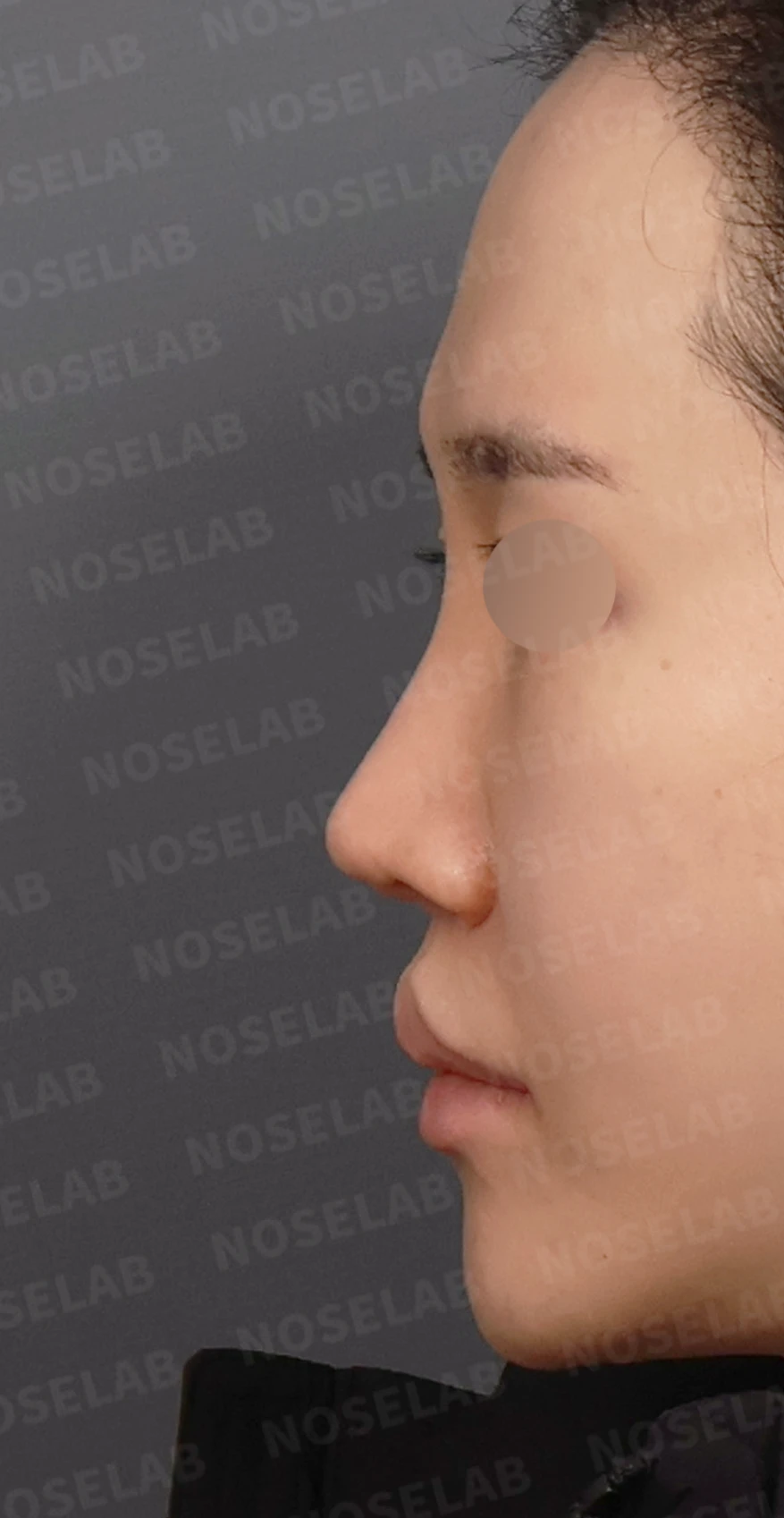 콧구멍 좌우가 심하게 달라 보이는 이유, 연골 재건과 피부이식 교정은 어떻게 하나 — 디자인 상담 정면, 좌측 측면, 비스듬한 측면 사진입니다.