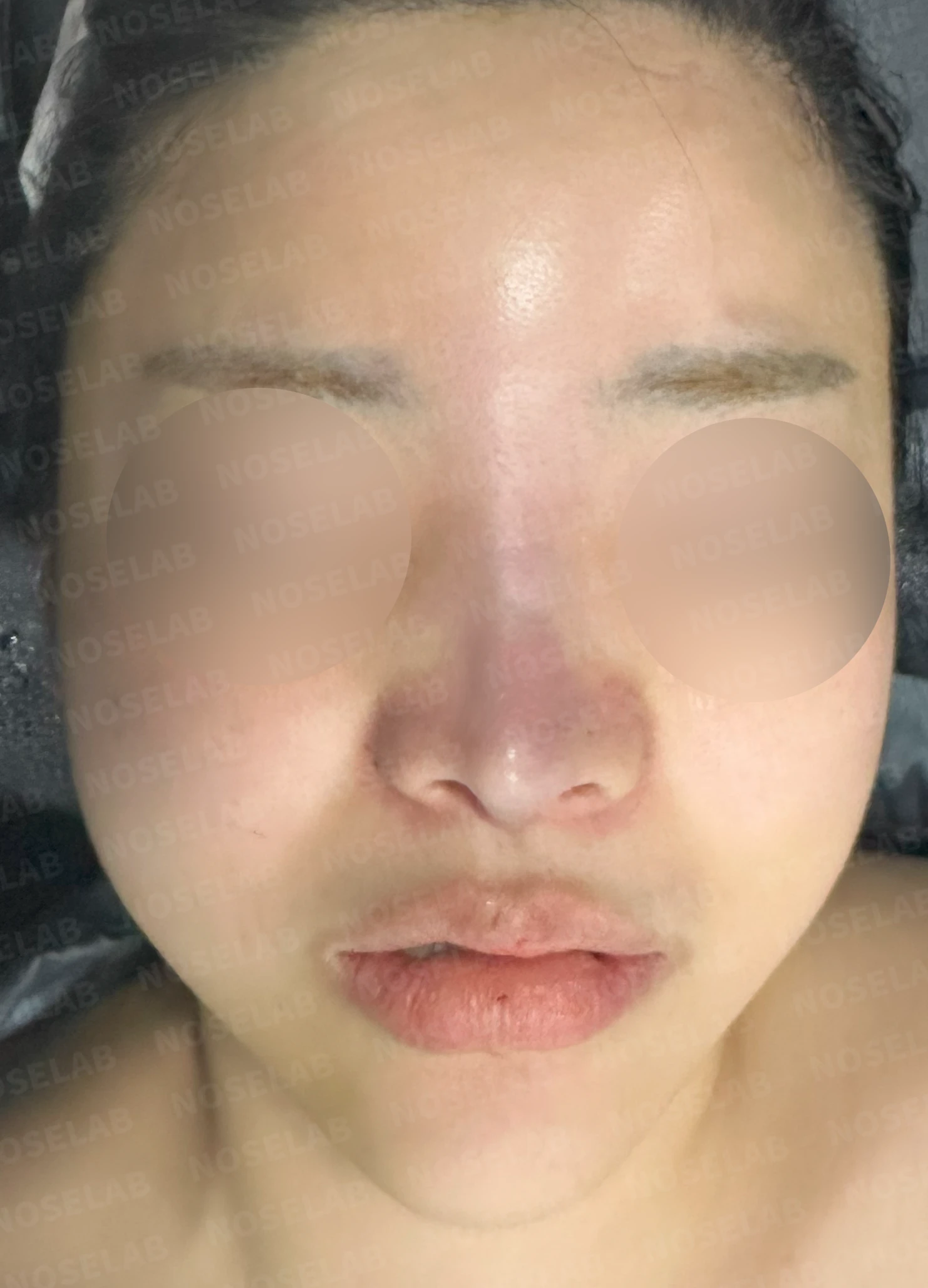 퍼진 콧대와 들린 코끝은 왜 생기나, 늑연골 재건은 어떻게 하나 — 수술 전 / 수술 직후 0일 직후 사진은 부기가 있는 상태로 최종 결과와 다를 수 있습니다.