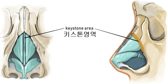 매부리코 수술 후 비대칭의 재수술 방법 — 본문 사진 7