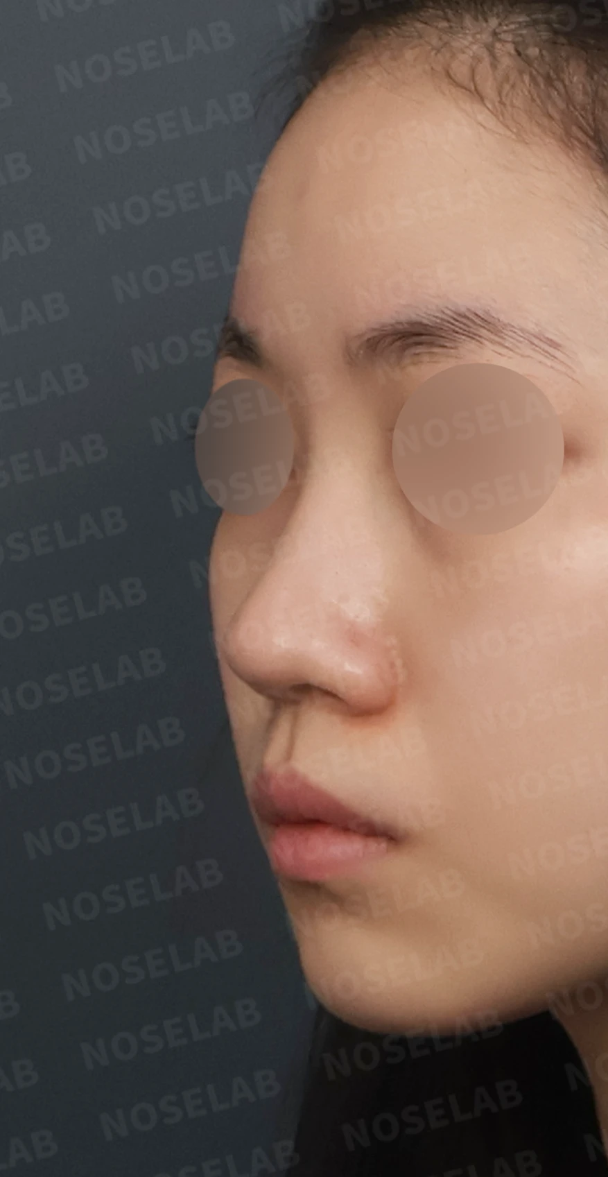 복코와 주먹코, 자가늑연골로 얄쌍하고 여성스러운 코 완성 — 디자인 상담 정면, 좌측 측면, 비스듬한 측면 사진입니다.