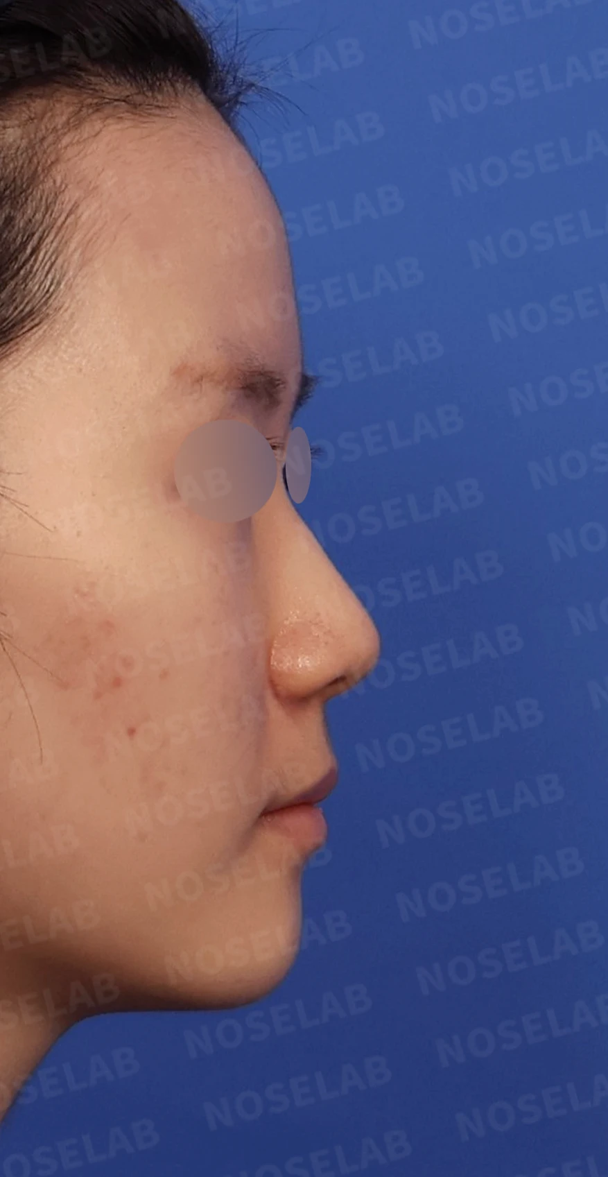 콧대가 퍼져 보이고 코끝이 뭉툭한 이유, 절골술과 자가 늑연골 교정은 어떻게 하나 — 디자인 상담 우측 측면, 비스듬한 측면, 비공 사진입니다.