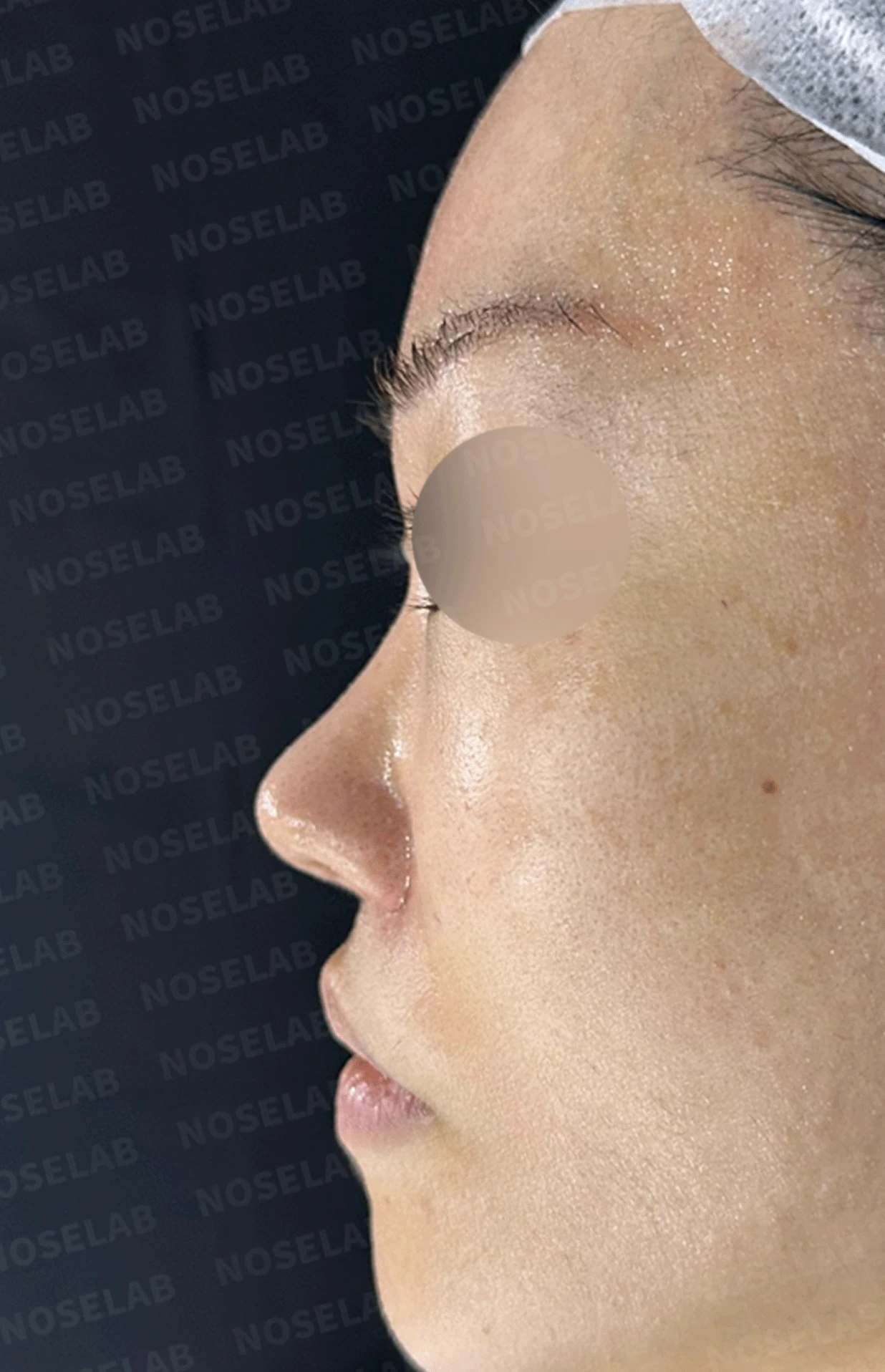 인공진피가 흡수되며 콧대가 낮아지고 퍼지는 이유 — 본문 사진 9