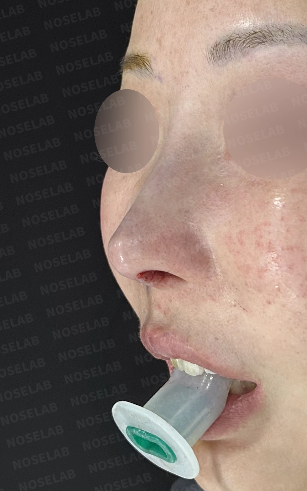 코성형 뒤 코막힘이 더 심해지는 이유, 비중격 재건과 절골 복원은 어떻게 하나 — 수술 전 / 수술 직후 0일 직후 사진은 부기가 있는 상태로 최종 결과와 다를 수 있습니다.