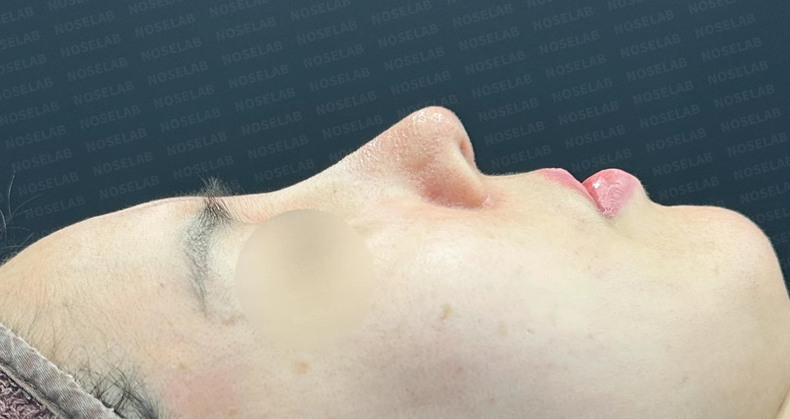 긴 코와 비대칭을 함께 교정하는 재수술 방법 — 수술 전 / 수술 직후 0일 직후 사진은 부기가 있는 상태로 최종 결과와 다를 수 있습니다.