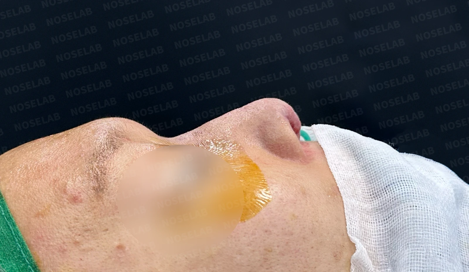 주입된 이물질을 제거하고 코를 재건하는 방법 — 제거된 이물질 사진 이물질이 제거된 사진