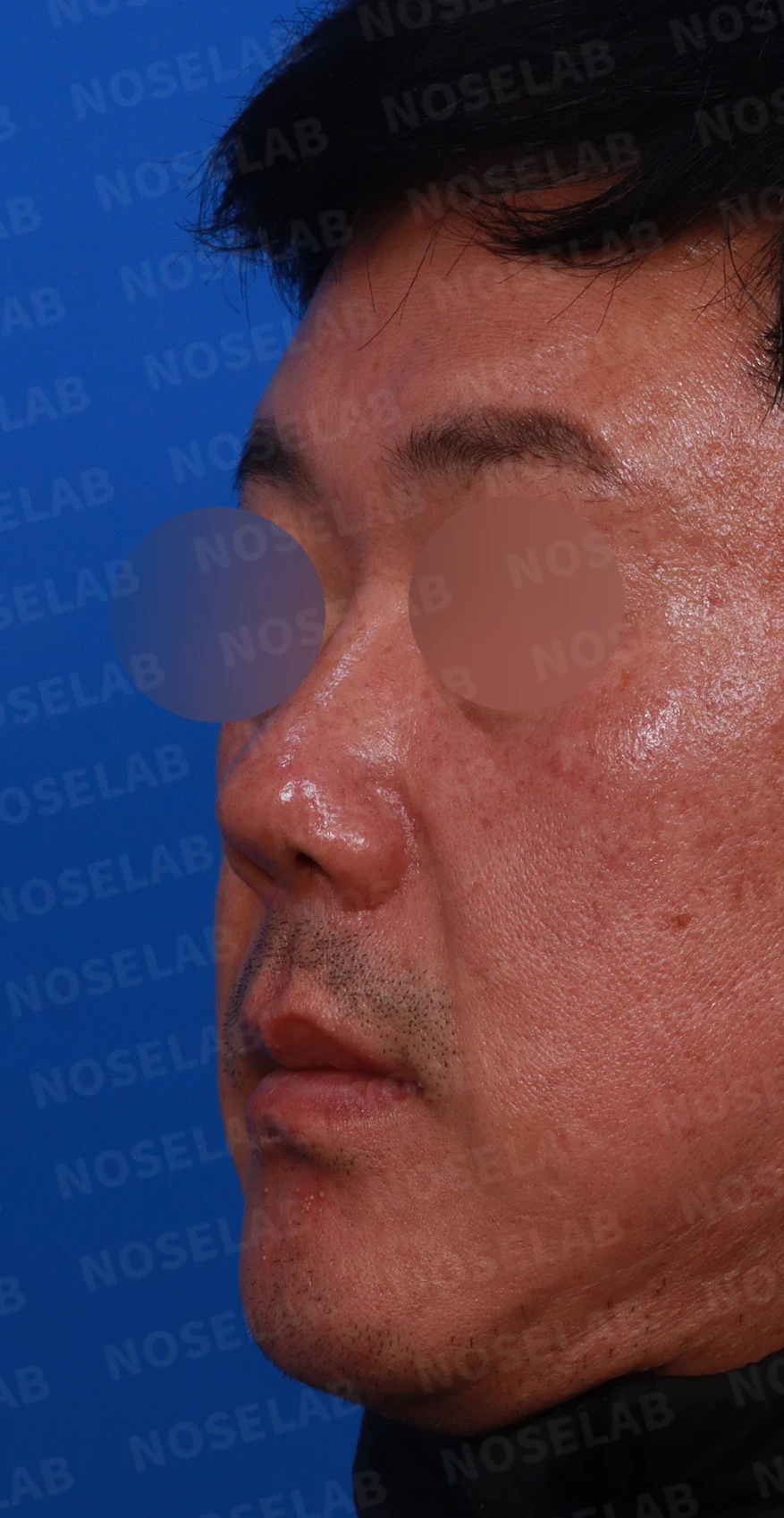 짧고 들린 코의 구조와 교정 방법 — 디자인 상담 정면, 좌측 측면, 비스듬한 측면 사진입니다.