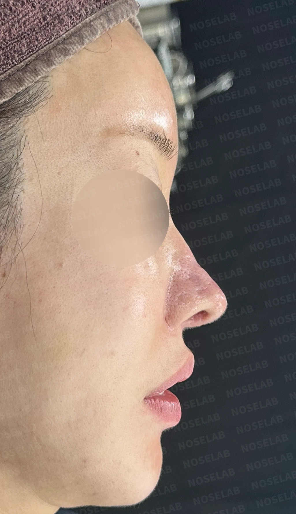 코 수술 뒤 콧등 피부가 괴사하면 어떤 변화가 남고, 재건은 어떻게 하나 — 수술 전 / 수술 직후 0일 직후 사진은 부기가 있는 상태로 최종 결과와 다를 수 있습니다.