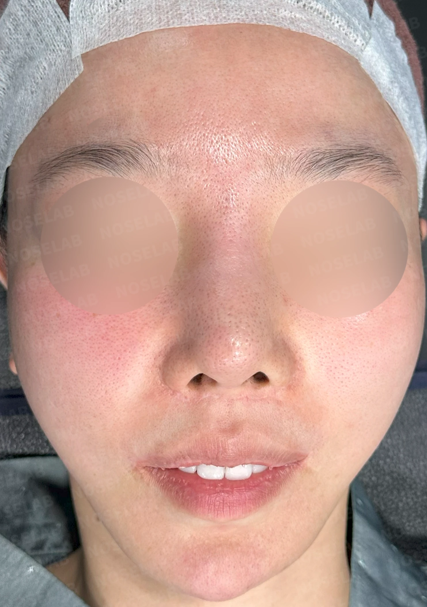 콧대가 뭉툭하게 퍼져 보이는 만성 이물 반응, 원인과 재건 방법 — 수술 전 / 수술 직후 0일 직후 사진은 부기가 있는 상태로 최종 결과와 다를 수 있습니다.