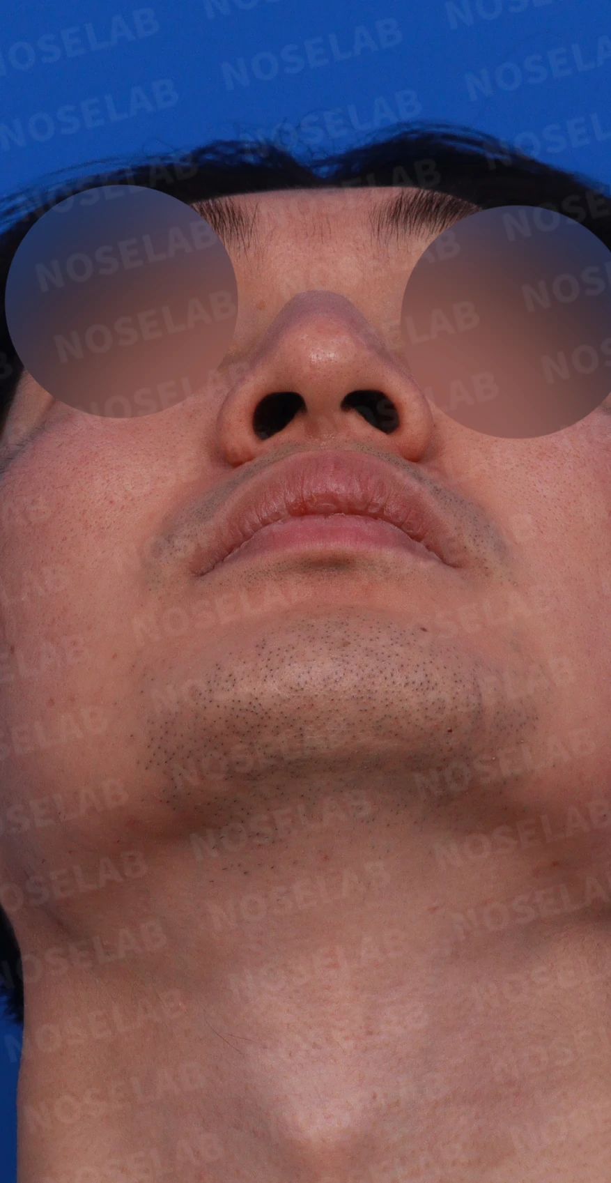 매부리코에 코막힘이 함께 오는 이유, 자가 늑연골만으로 하는 교정 방법 — 디자인 상담 우측 비스듬한 측면, 측면, 비공 사진입니다.