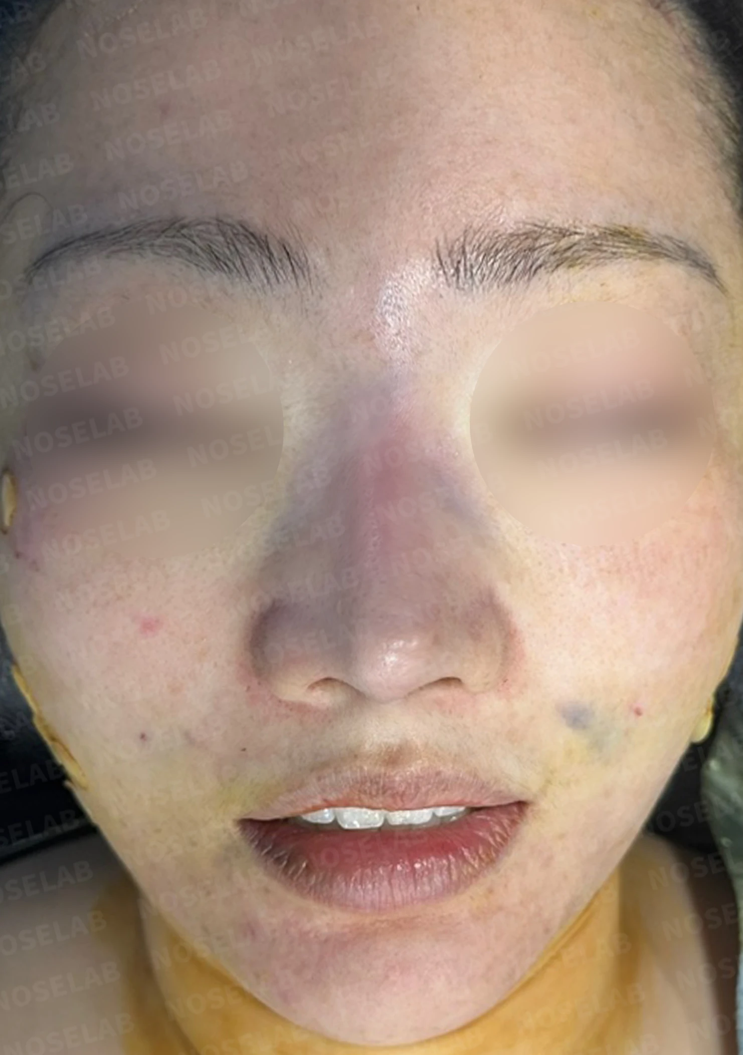 재수술한 코가 휘어 보이고 코끝이 처지는 이유 — 수술 전 / 수술 직후 0일 직후 사진은 부기가 있는 상태로 최종 결과와 다를 수 있습니다.