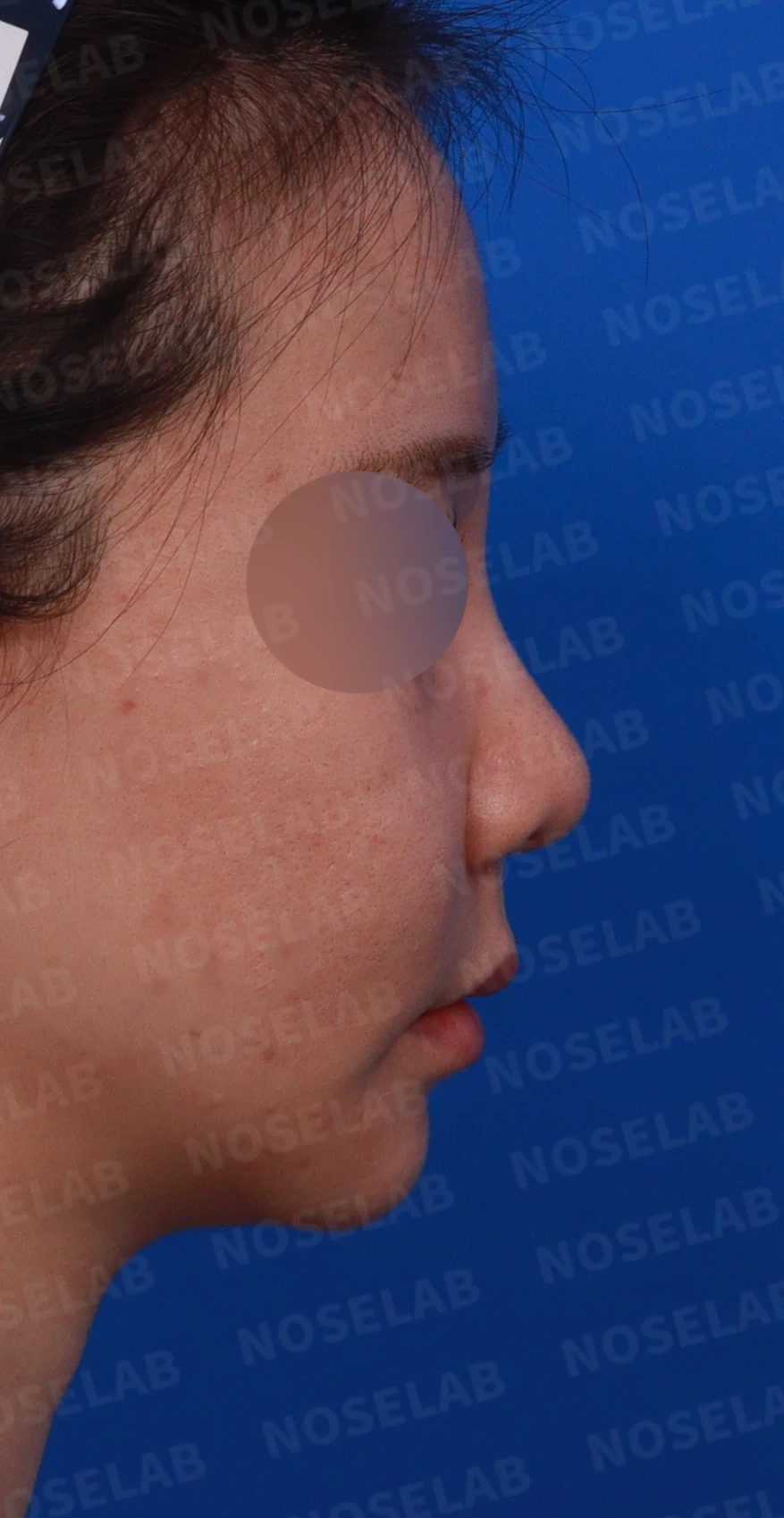 필러와 실 시술 뒤 코가 뭉툭해지는 이유, 이물질 제거와 코끝 교정 방법 — 디자인 상담 우측 비스듬한 측면, 측면, 비공 사진