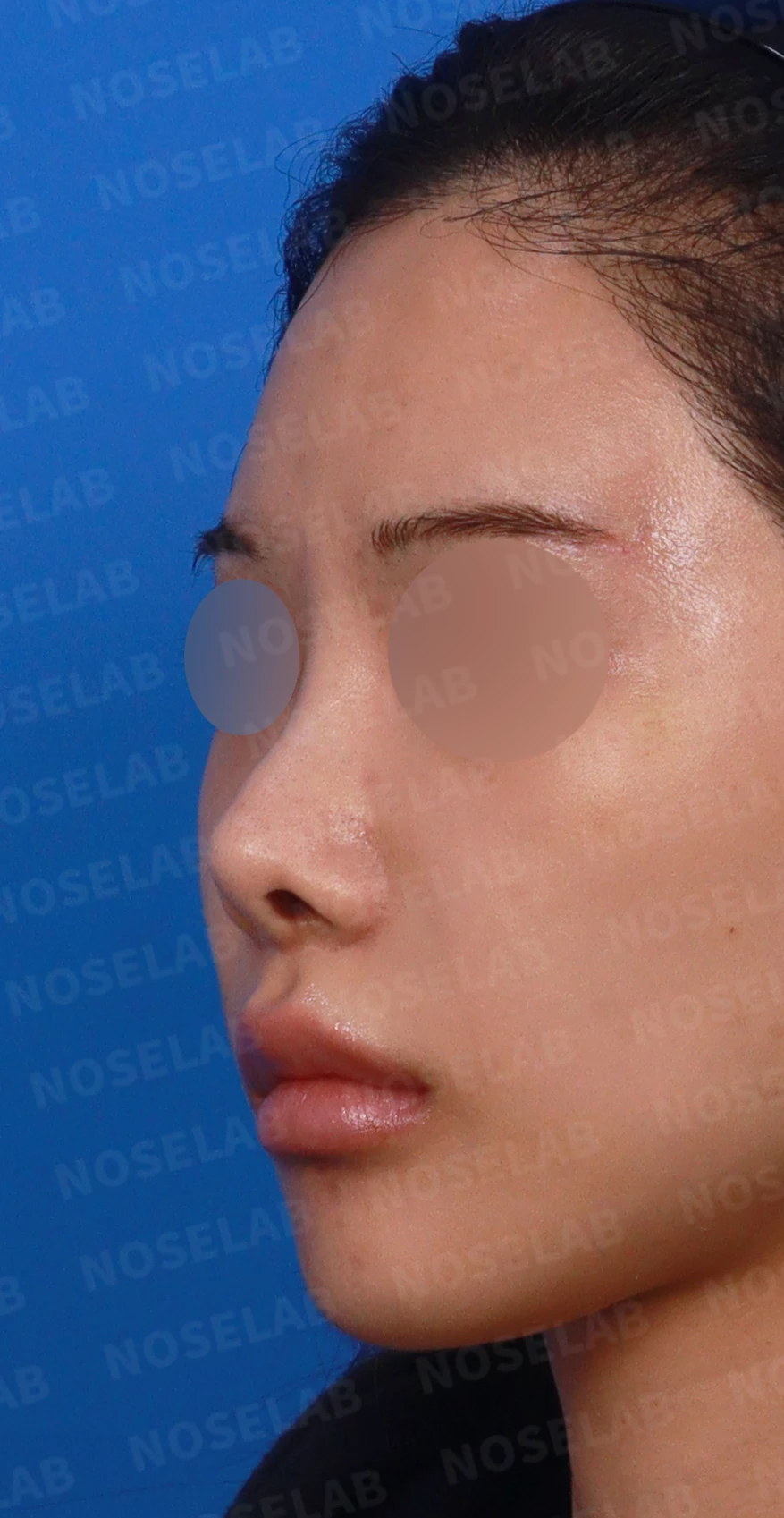 콧대 반영구 필러가 남기는 변화와 제거 후 비중격 재건 — 디자인 상담 정면, 좌측 측면, 비스듬한 측면 사진입니다.