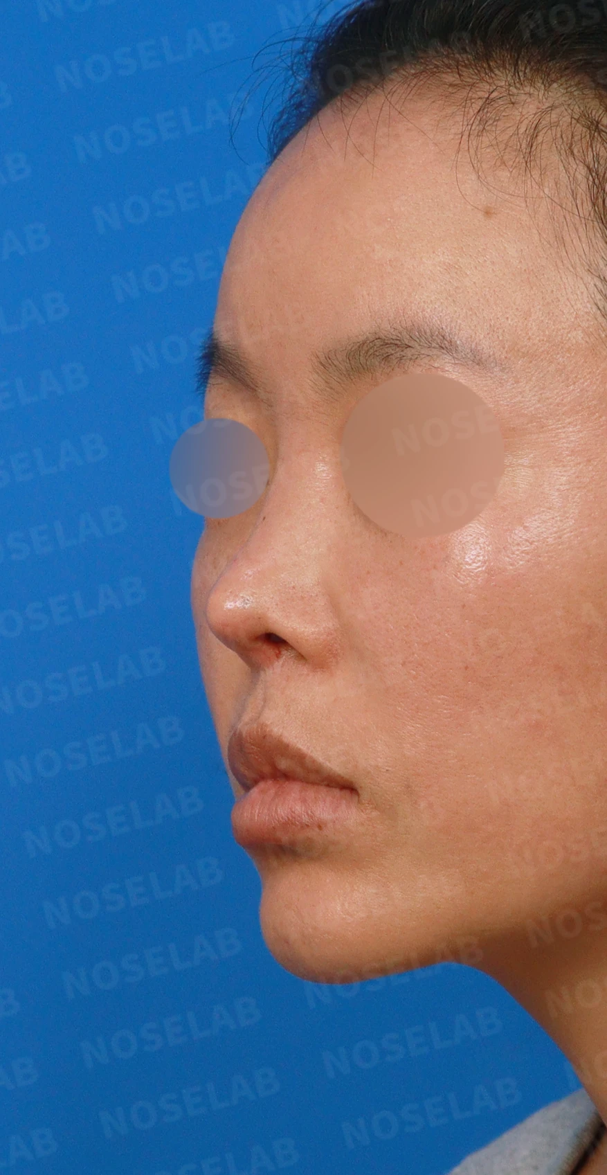 이식한 진피가 흡수되어 콧대가 퍼지고 코가 들려 보이는 이유와 교정 방법 — 디자인 상담 정면, 좌측 측면, 비스듬한 측면 사진입니다.