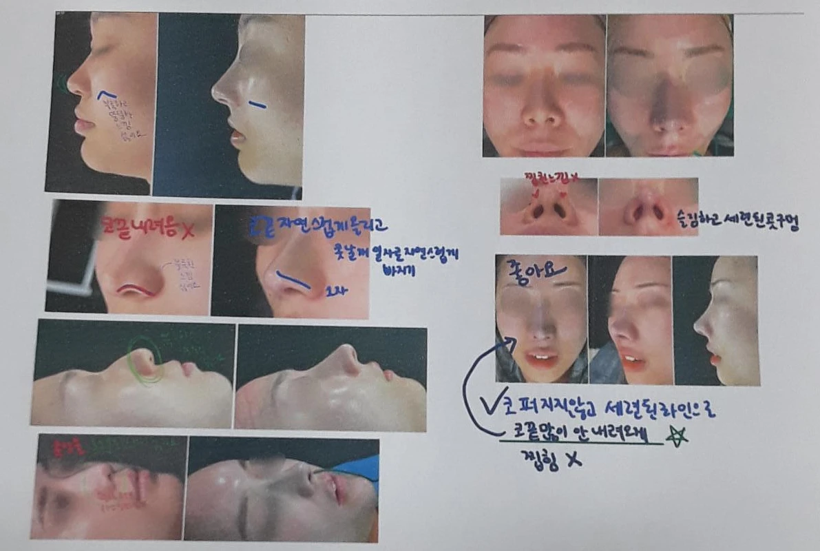 콧볼 축소 뒤 코가 뭉툭하고 길어 보이는 이유, 어떻게 교정하나 — 본문 사진 8