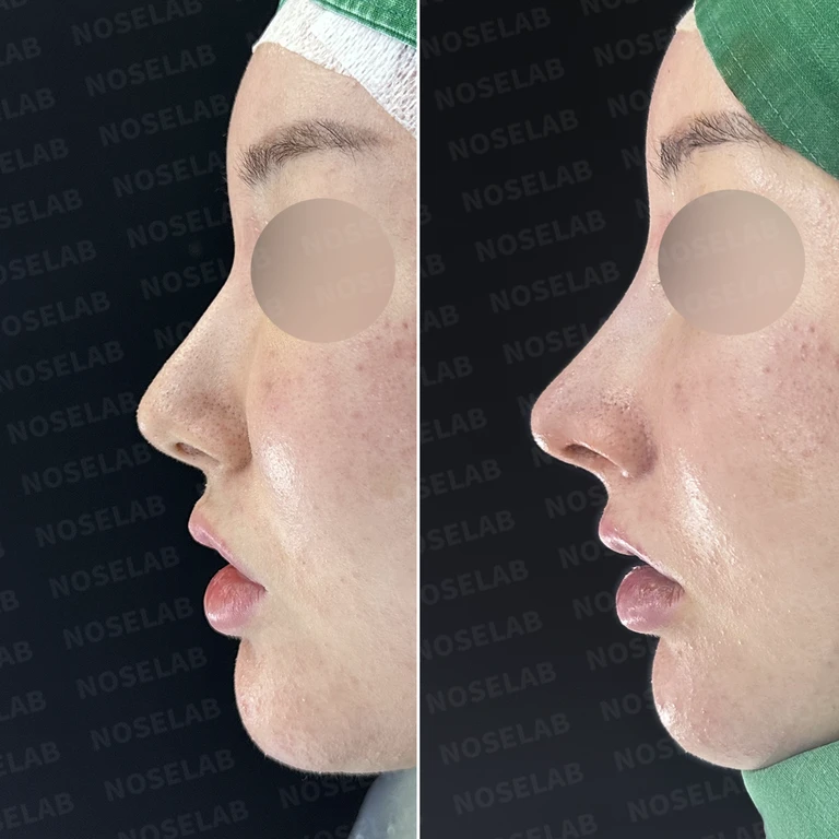 길고 비대칭한 코, 여성스럽고 짧아 보이는 예쁜 코로 화려한 변신 — 전후 비교