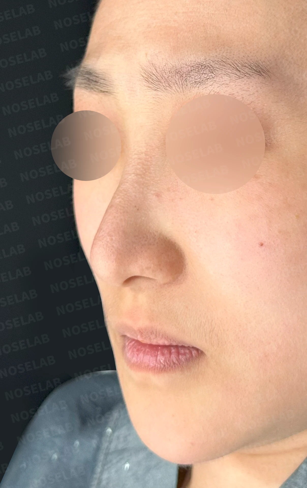 코가 한쪽으로 휘어 보이고 밤에 막히는 이유, 비중격 재건과 코막힘 개선 — 본문 사진 11