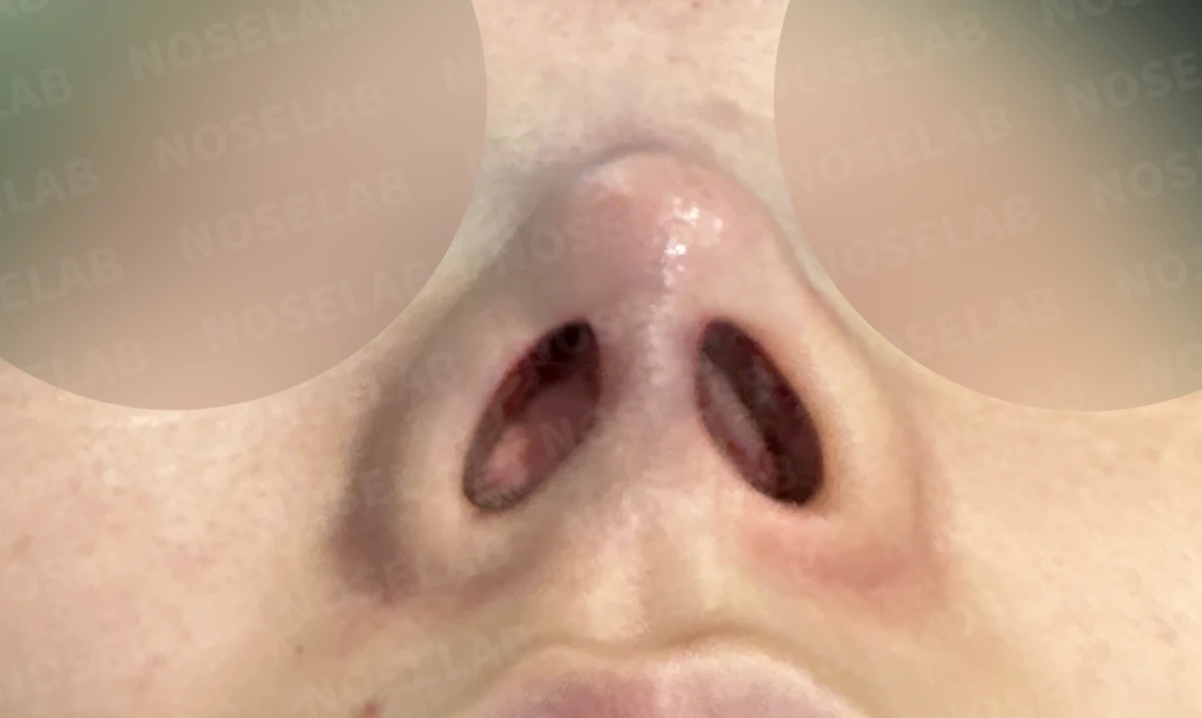 퍼진 코끝에 코막힘이 함께 오는 이유, 이물질 제거와 재건은 어떻게 하나 — 수술 전 / 수술 직후 0일 직후 사진은 부기가 있는 상태로 최종 결과와 다를 수 있습니다.