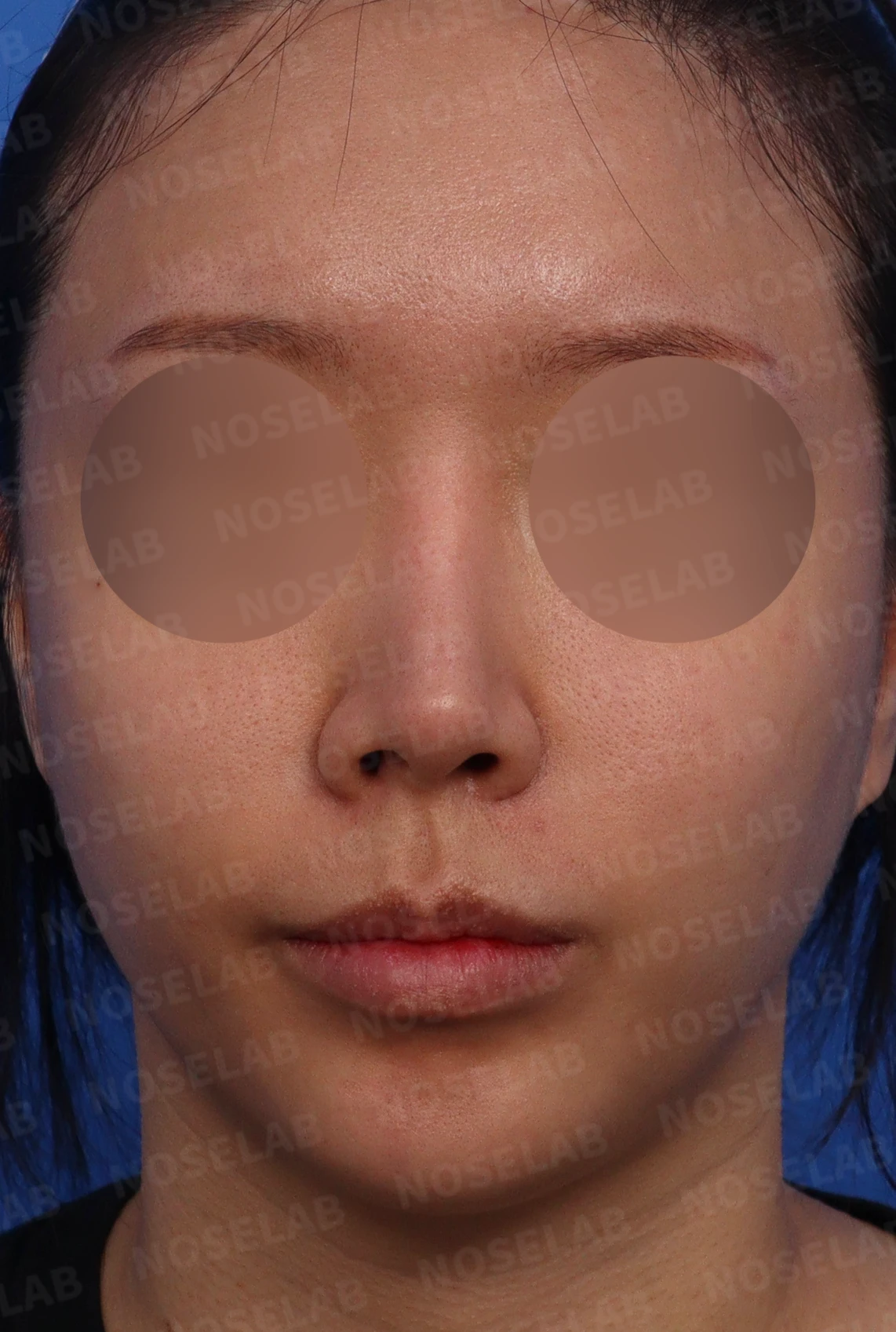 휜코와 콧구멍 비대칭, 호흡을 함께 고려한 교정 방법 — 수술전 디자인 상담 정면, 비스듬한 측면, 측면 사진입니다.