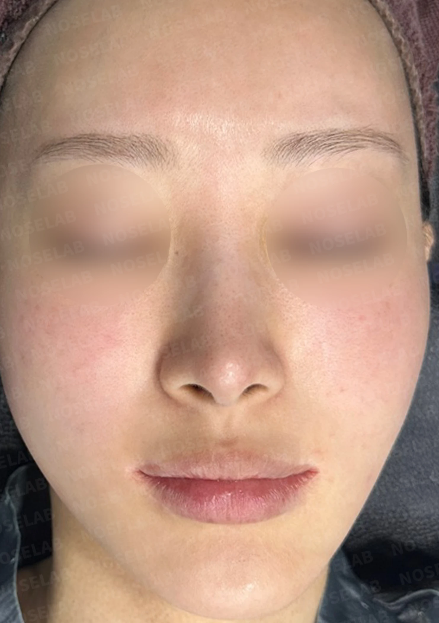 뾰족한 코끝과 연골 비침 - 자가진피 코 재수술 후기 — 전(좌) 직후(우)