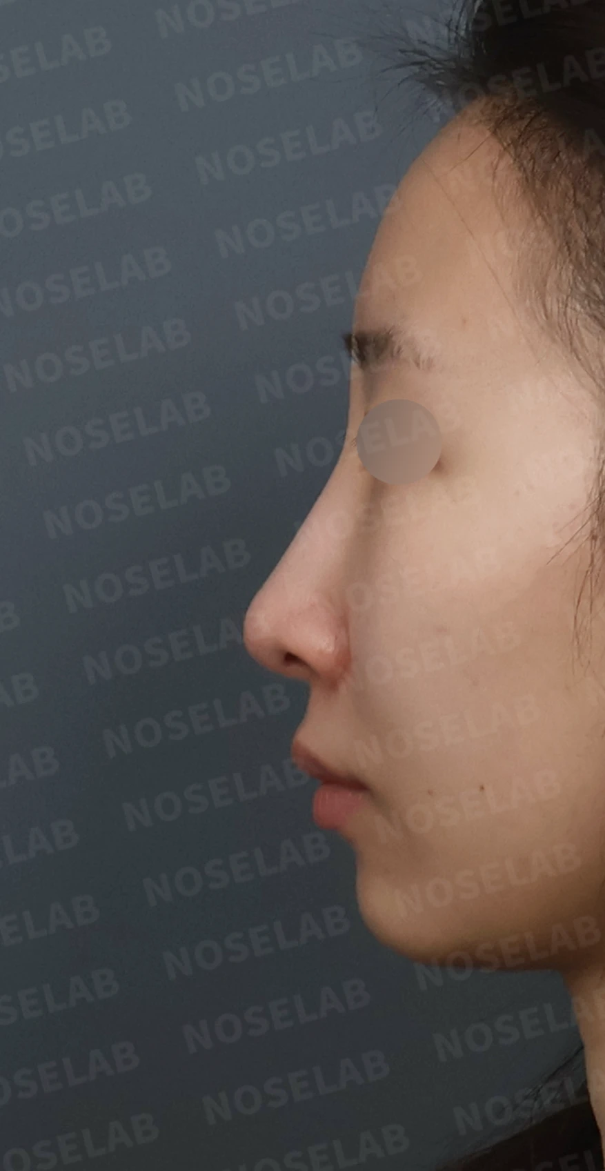 길고 처진 코, 휜코 교정과 코막힘까지 한 번에 해결한 재수술 사례 — 디자인 상담 정면, 좌측 측면, 비스듬한 측면 사진입니다.