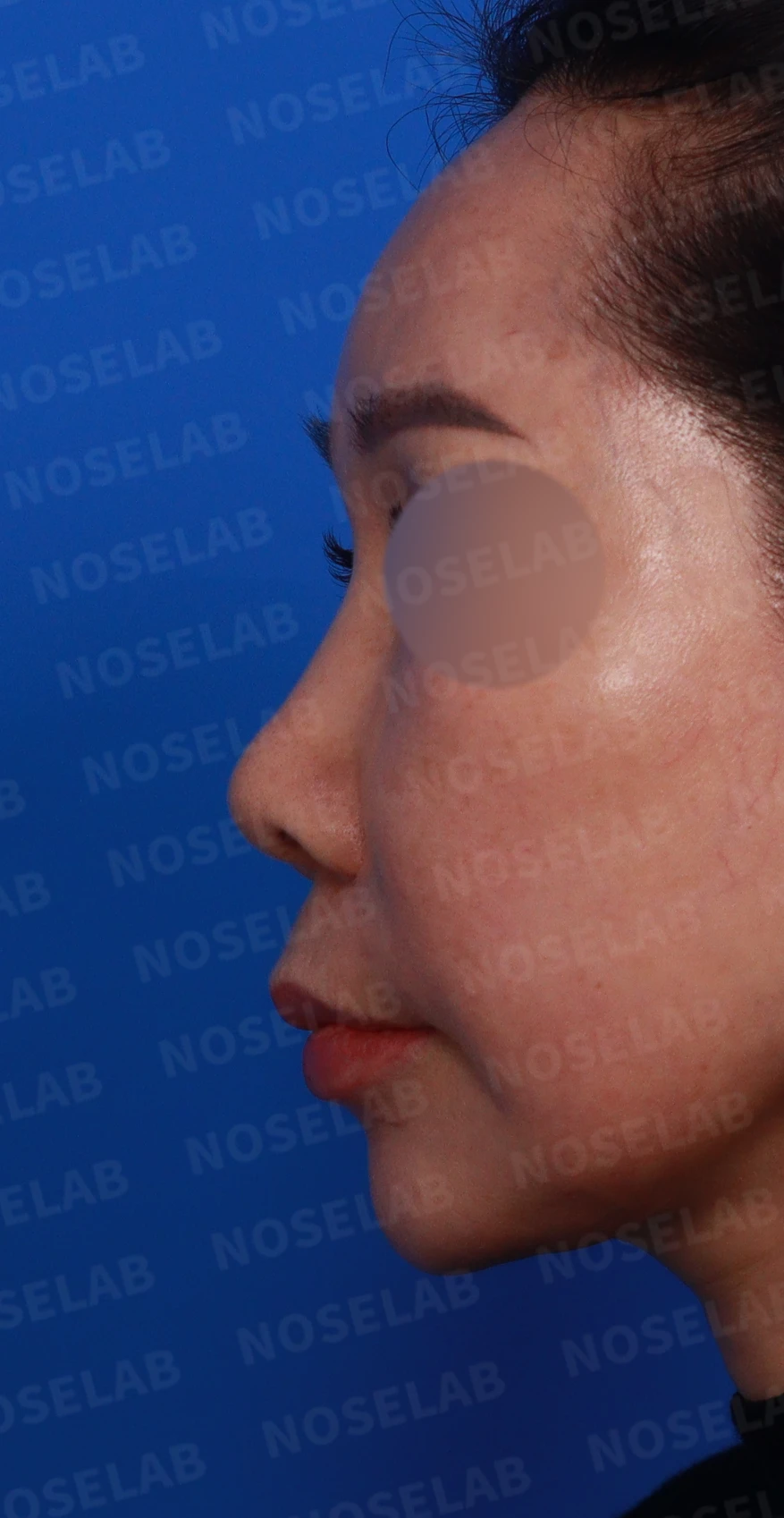 코 안에 남은 메드포어와 이물질, 왜 문제가 되고 어떻게 제거하나 — 디자인 상담 정면, 좌측 측면, 비스듬한 측면 사진