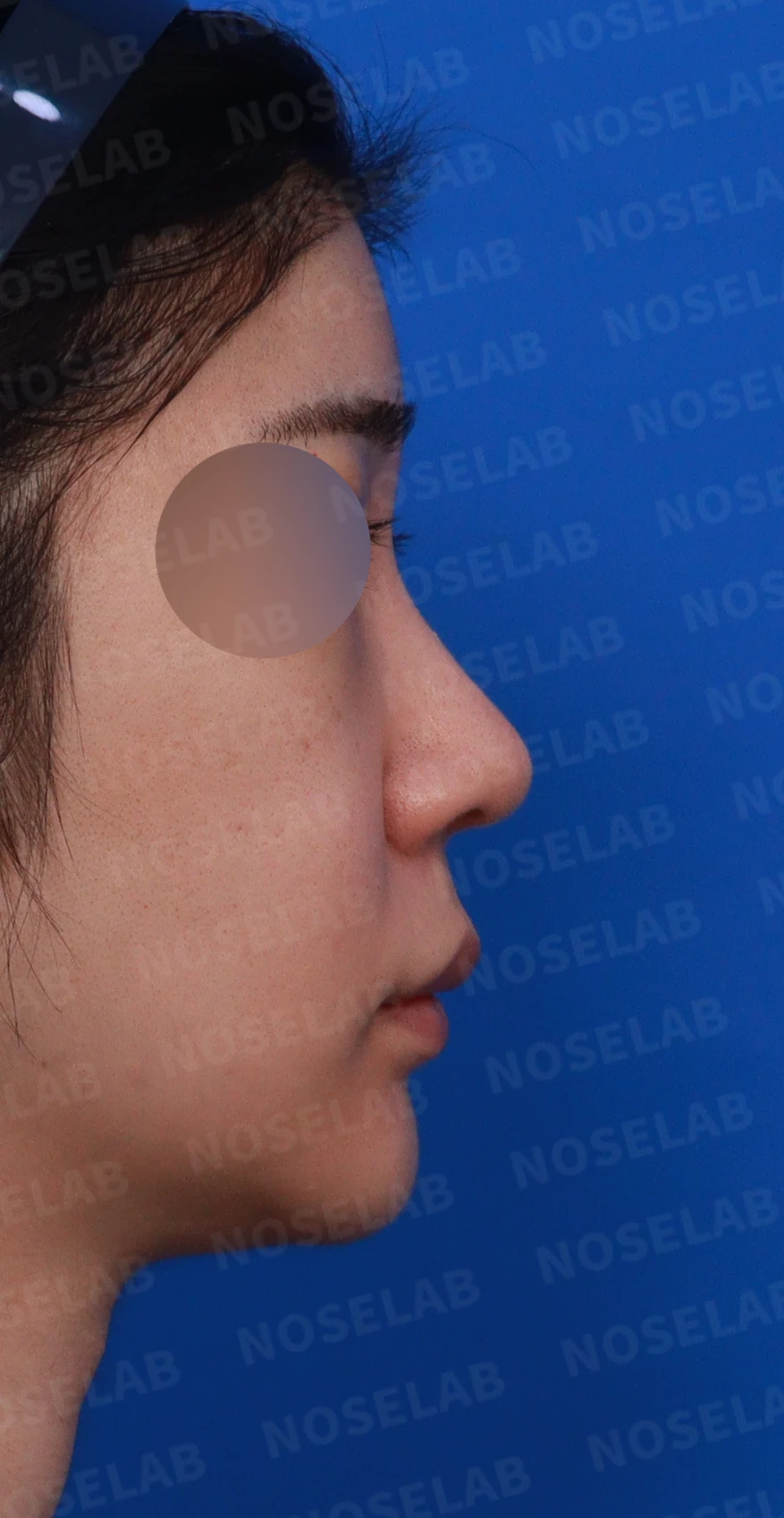 코가 뭉툭하고 퍼져 보이는 이유, 비순각과 비주는 어떻게 교정하나 — 디자인 상담 우측 비스듬한 측면, 측면, 비공 사진