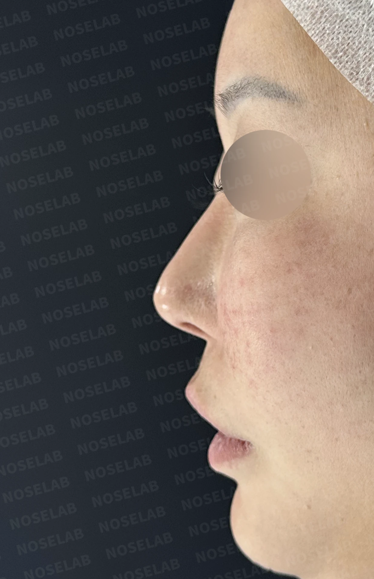 코성형 뒤 코막힘이 더 심해지는 이유, 비중격 재건과 절골 복원은 어떻게 하나 — 수술 전 / 수술 직후 0일 직후 사진은 부기가 있는 상태로 최종 결과와 다를 수 있습니다.