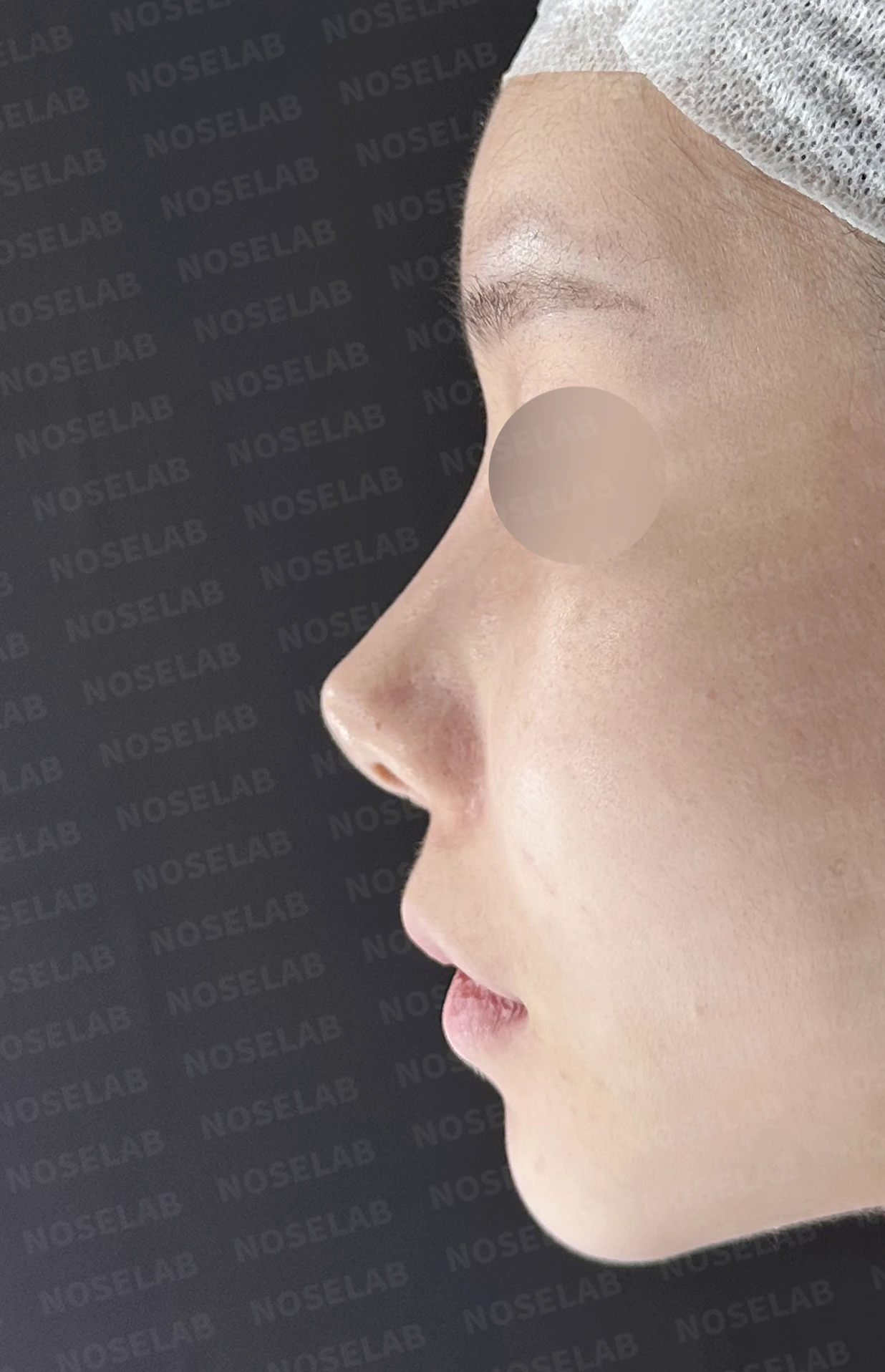 코성형 뒤 코끝이 들리고 비주가 짧아 보이는 이유, 비주 하강과 콧대 라인 교정 방법 — 수술 전 / 수술 직후 0일 직후 사진은 부기가 있는 상태로 최종 결과와 다를 수 있습니다.