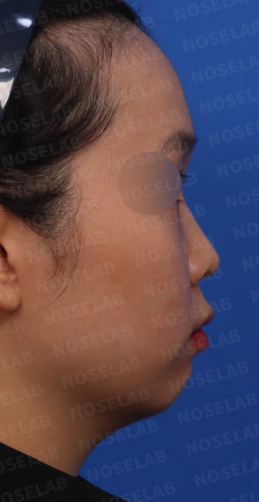 짧은 코의 비개방 교정 방법과 얼굴 비율 — 수술전 디자인 상담 측면 사진입니다.