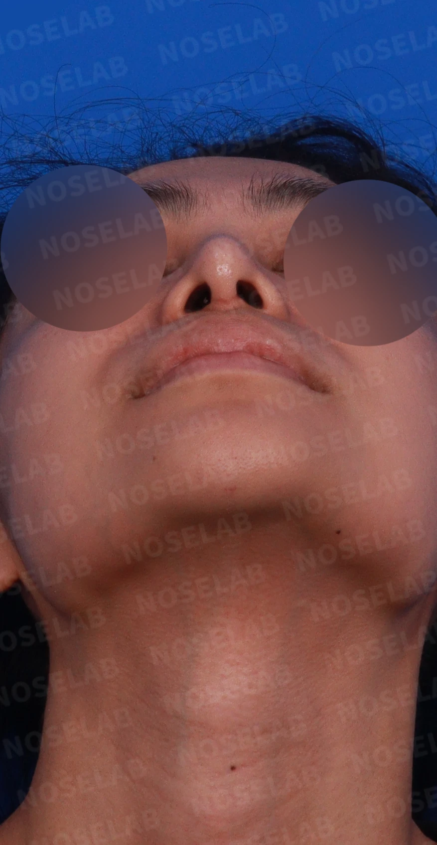 비주가 심하게 처지고 화살코가 되는 이유와 늑연골 재건 방법 — 디자인 상담 우측 측면, 비스듬한 측면, 비공 사진입니다.