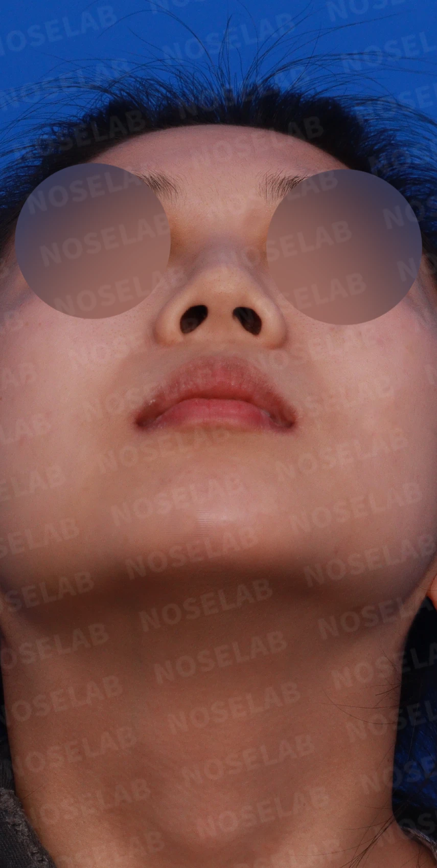 작은 코와 비공 비대칭을 함께 살펴보는 교정 방법 — 본문 사진 6