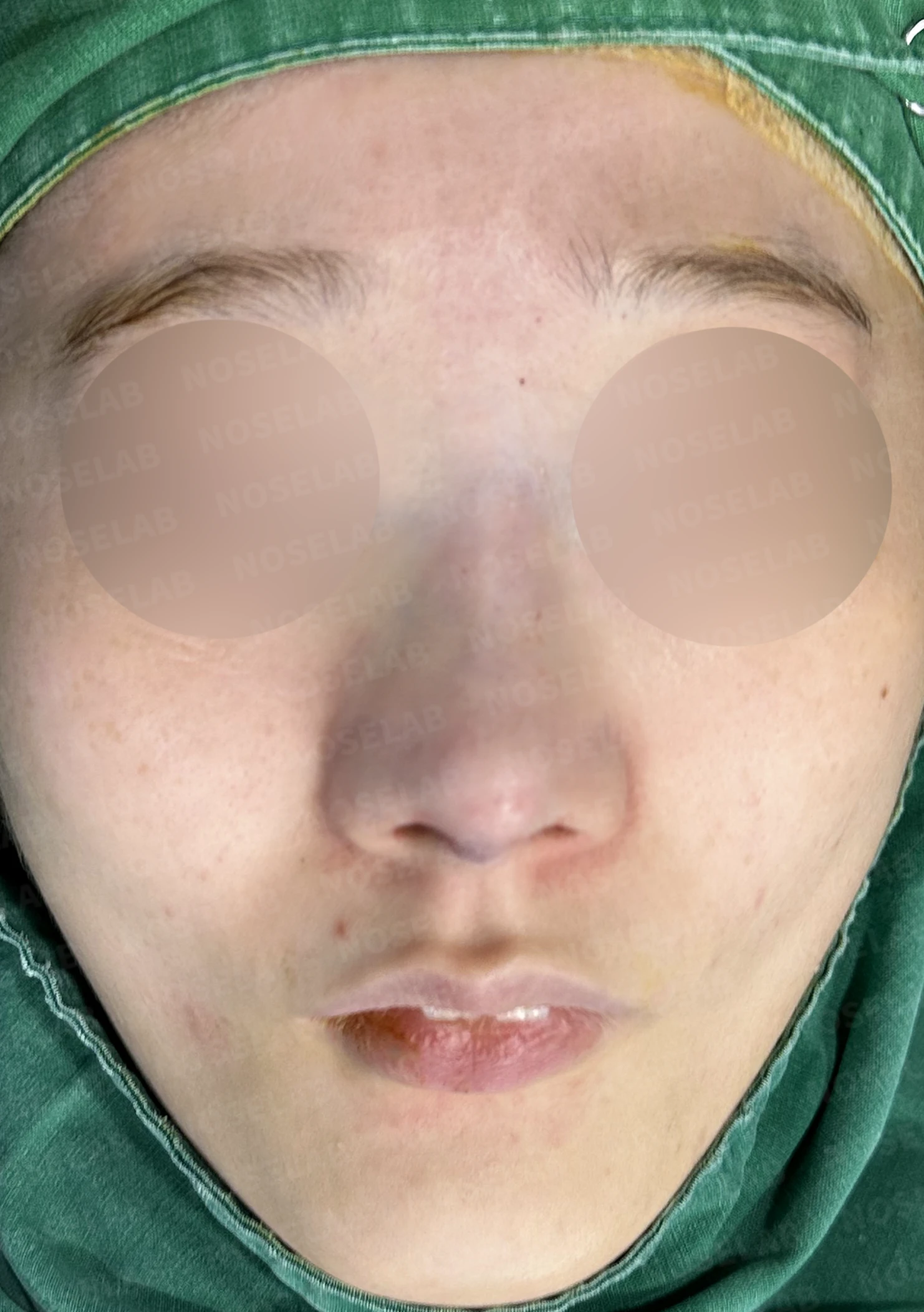 퍼진 코끝에 코막힘이 함께 오는 이유, 이물질 제거와 재건은 어떻게 하나 — 수술 전 / 수술 직후 0일 직후 사진은 부기가 있는 상태로 최종 결과와 다를 수 있습니다.
