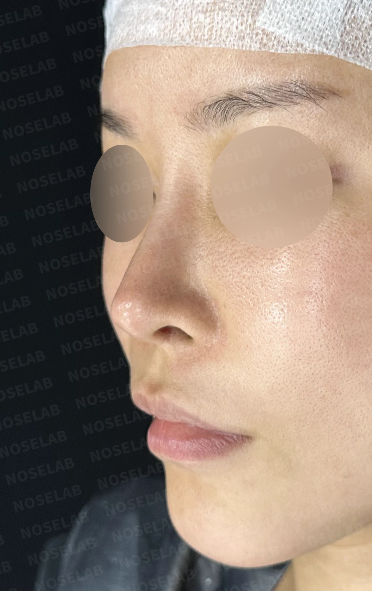 비중격 완전 재건으로 오똑한 코끝과 비공 비대칭 교정 — 전(좌) , 직후(후)