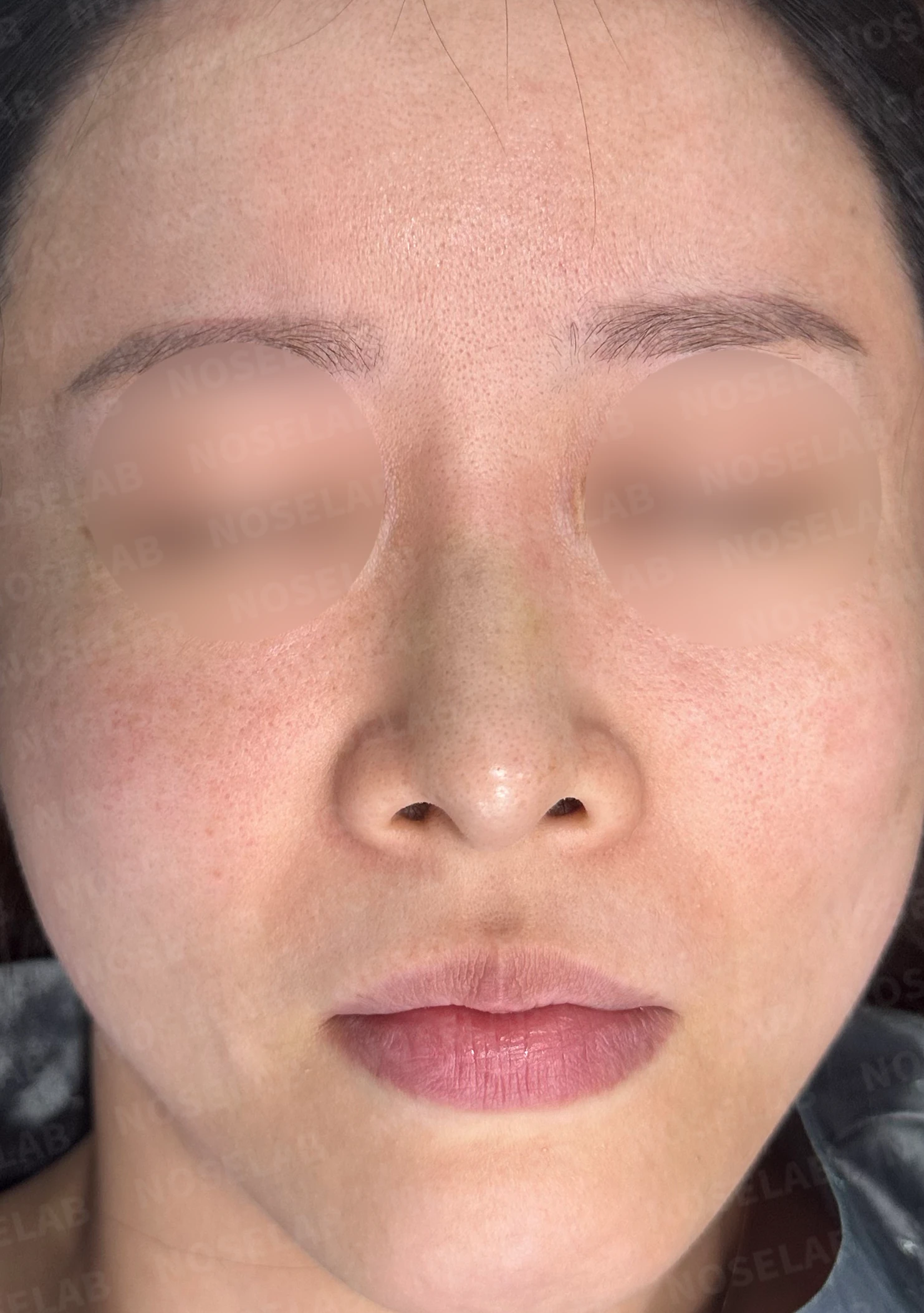 짧고 들린 코를 교정하는 재수술 방법 — 수술 전 / 수술 직후 0일 직후 사진은 부기가 있는 상태로 최종 결과와 다를 수 있습니다.