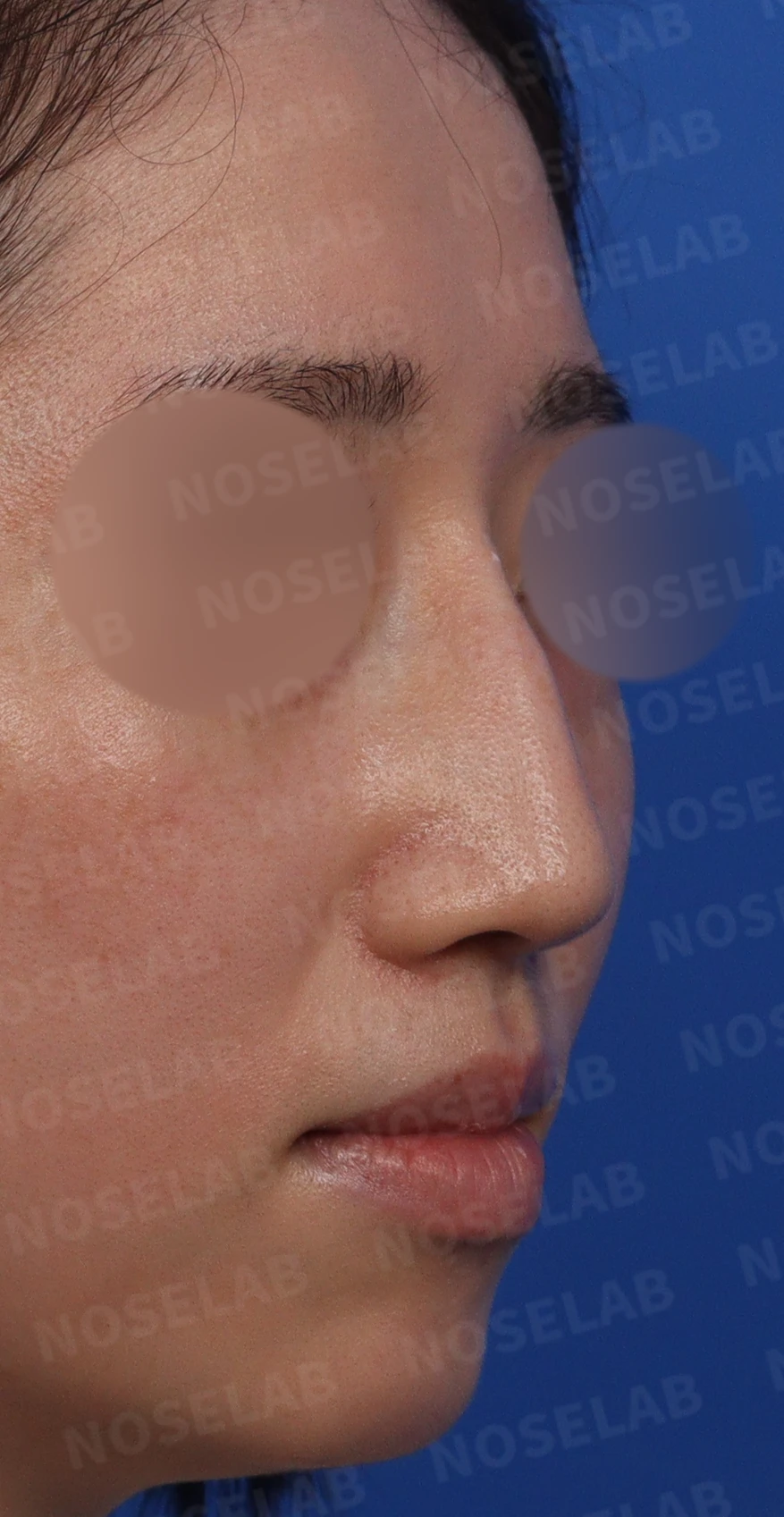 이물질(메쉬·실) 제거후 코성형 방법 — 본문 사진 3